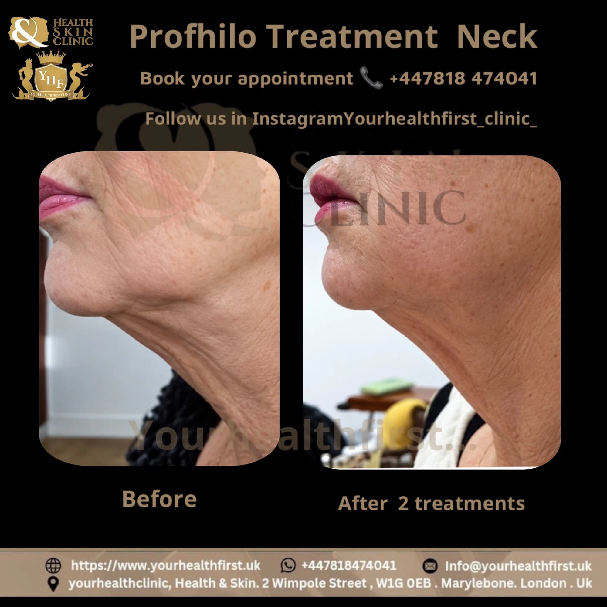 Profhilo lower face & neck before & after — result 4