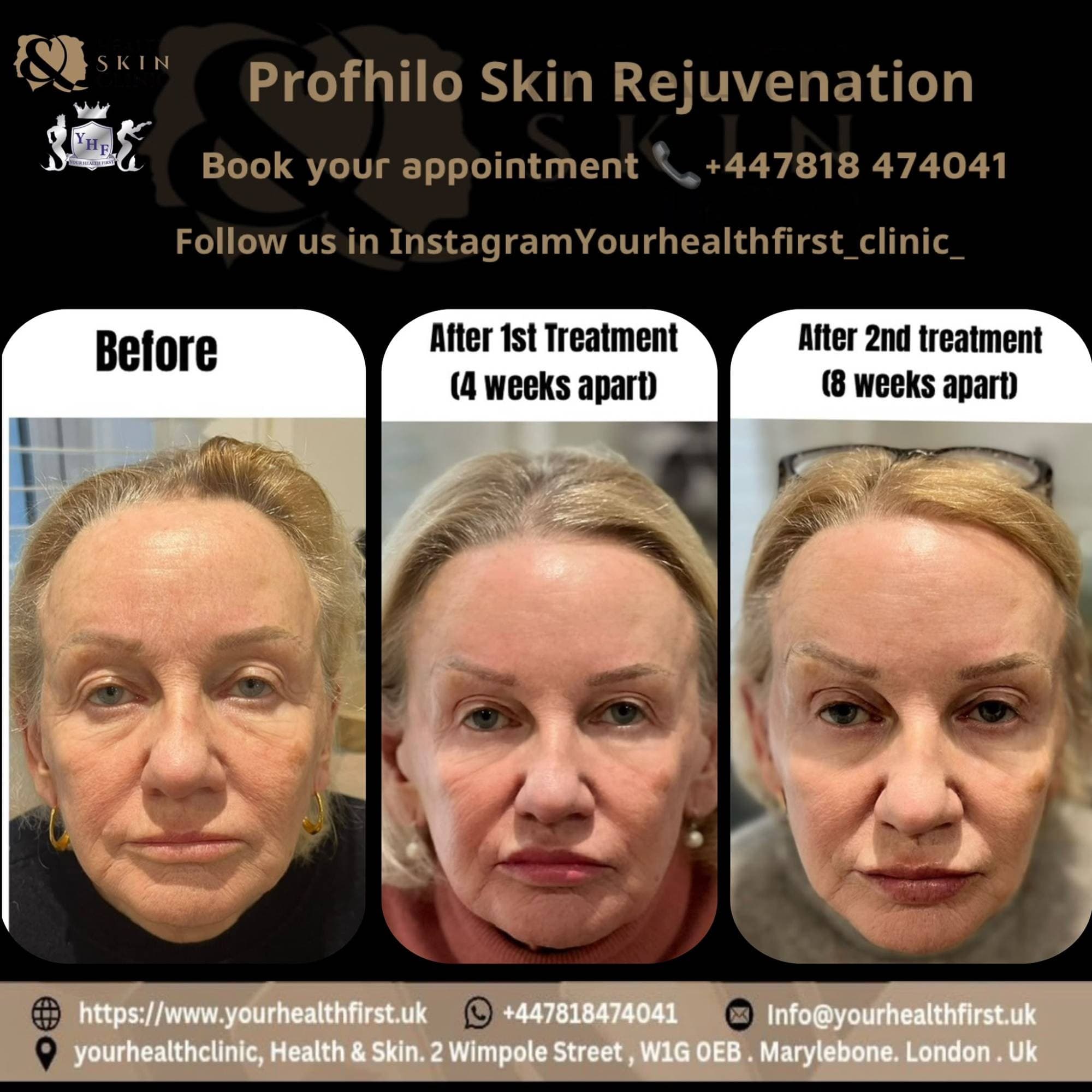 Profhilo lower face & neck before & after — result 5