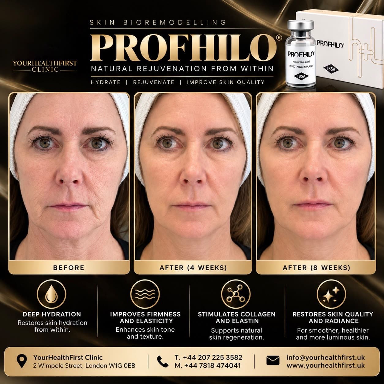 Profhilo lower face & neck before & after — result 6