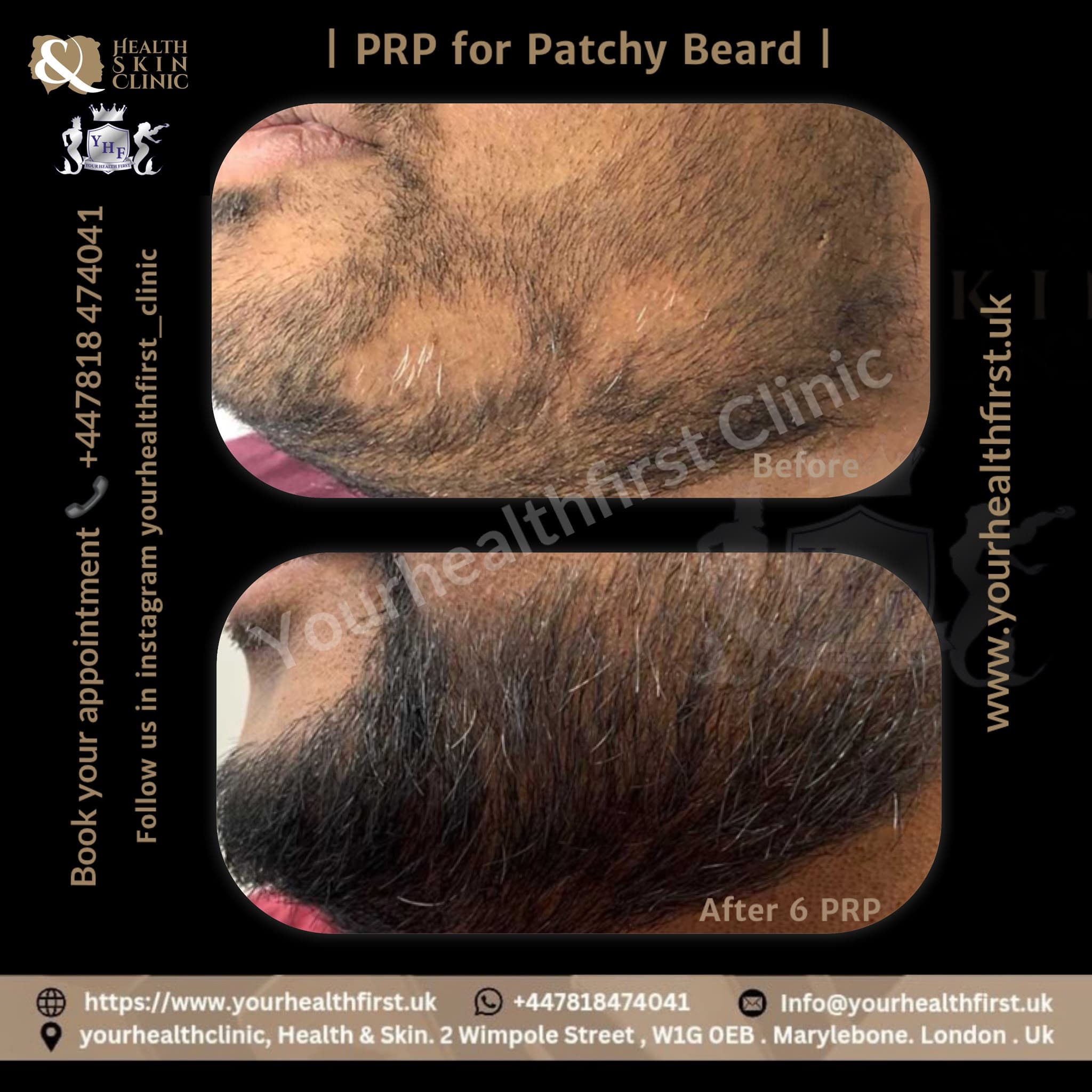 PRP patchy beard restoration before & after — result 1