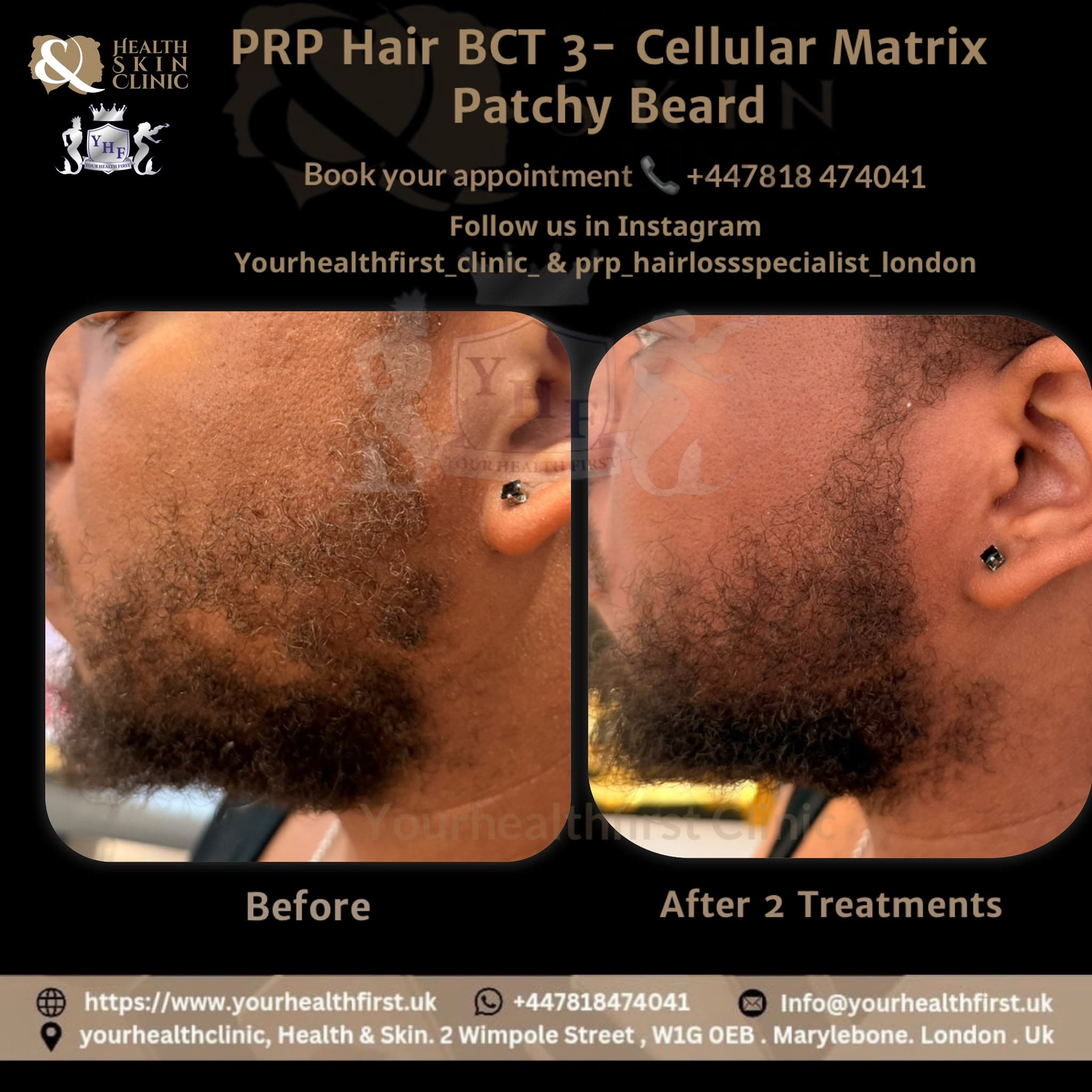 PRP patchy beard restoration before & after — result 2
