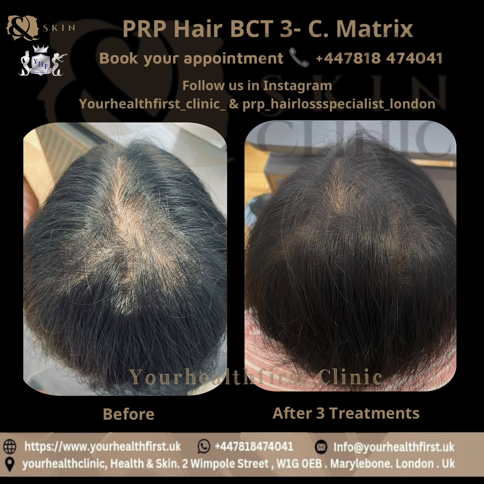 PRP hair loss (women) before & after — result 2