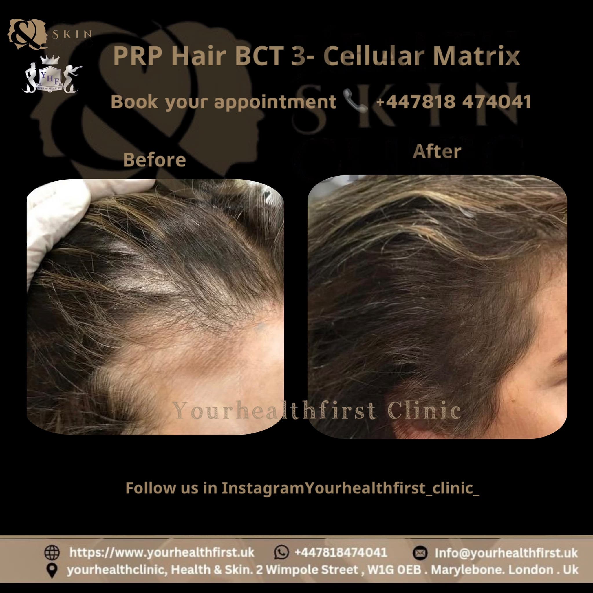 PRP hair loss (women) before & after — result 3