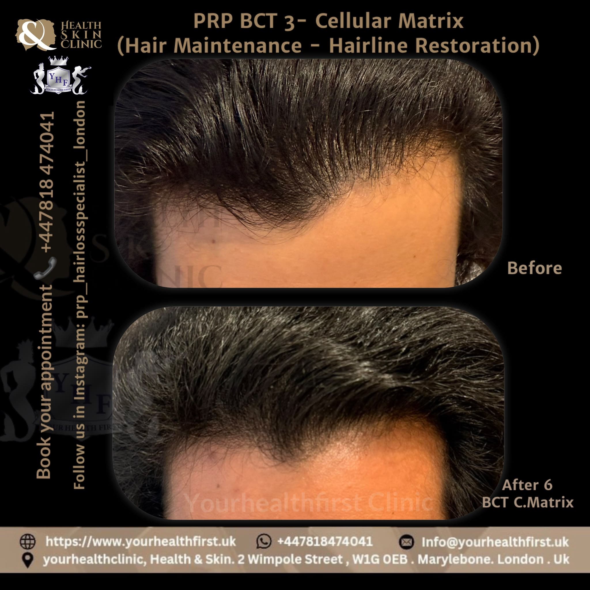 PRP Hair Loss Treatment before & after — result 1