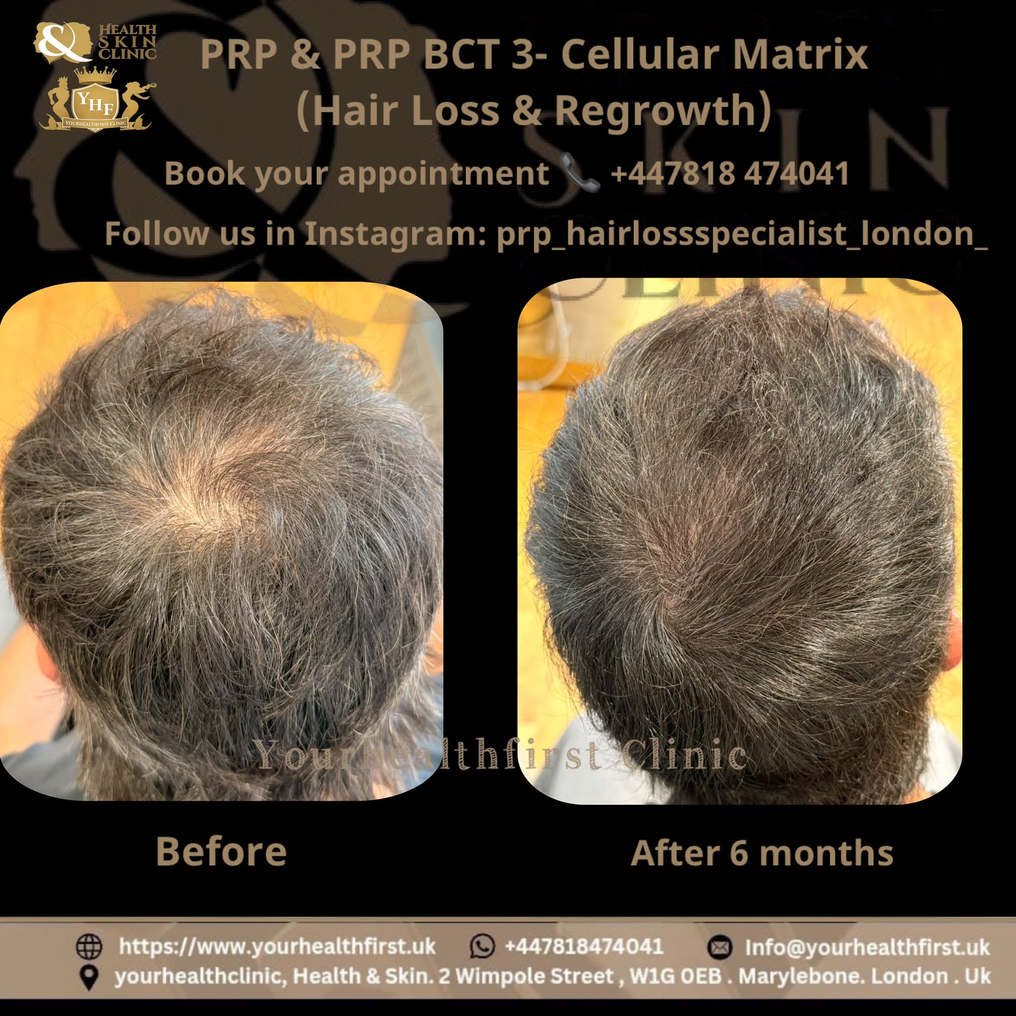 PRP Hair Loss Treatment before & after — result 2