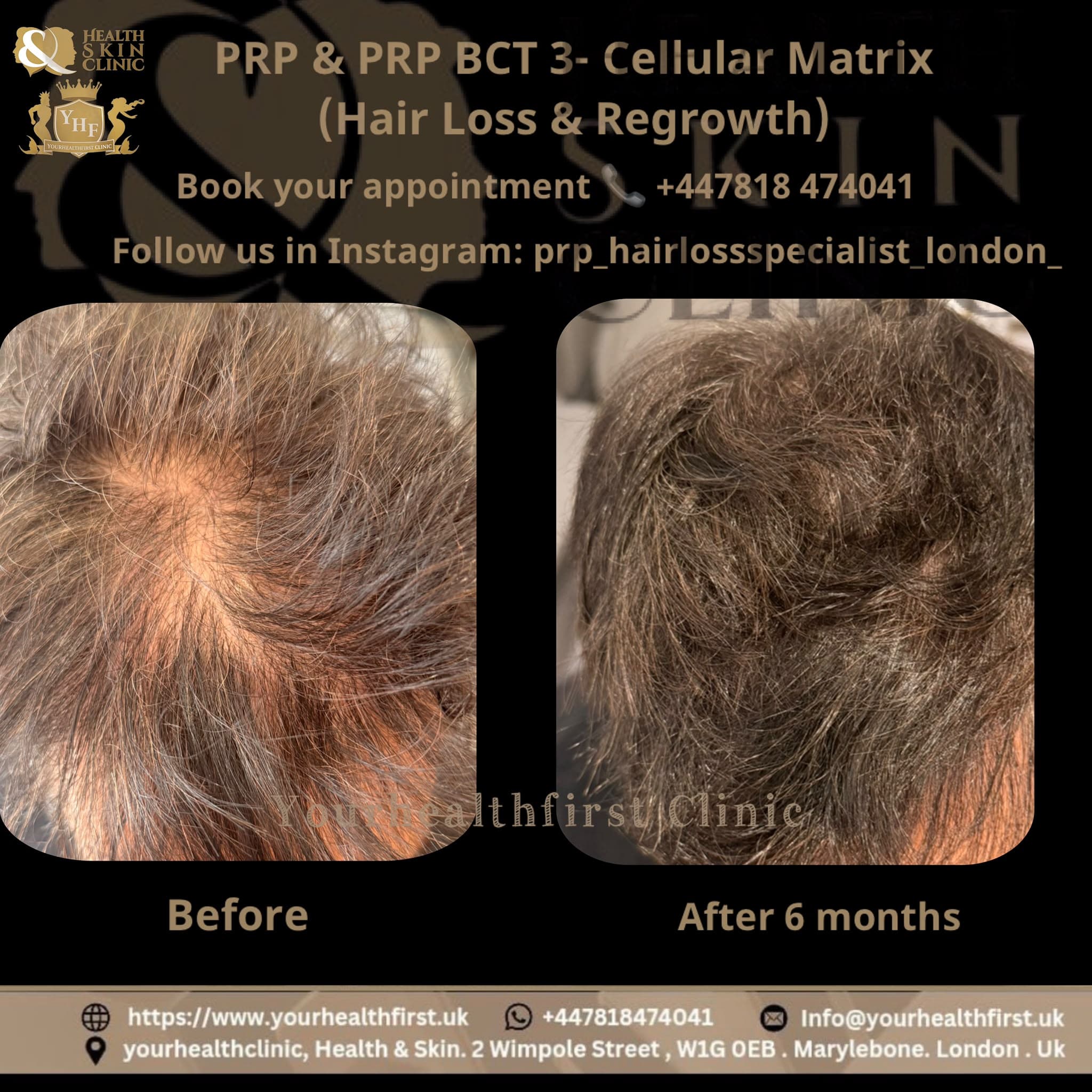 PRP Hair Loss Treatment before & after — result 3