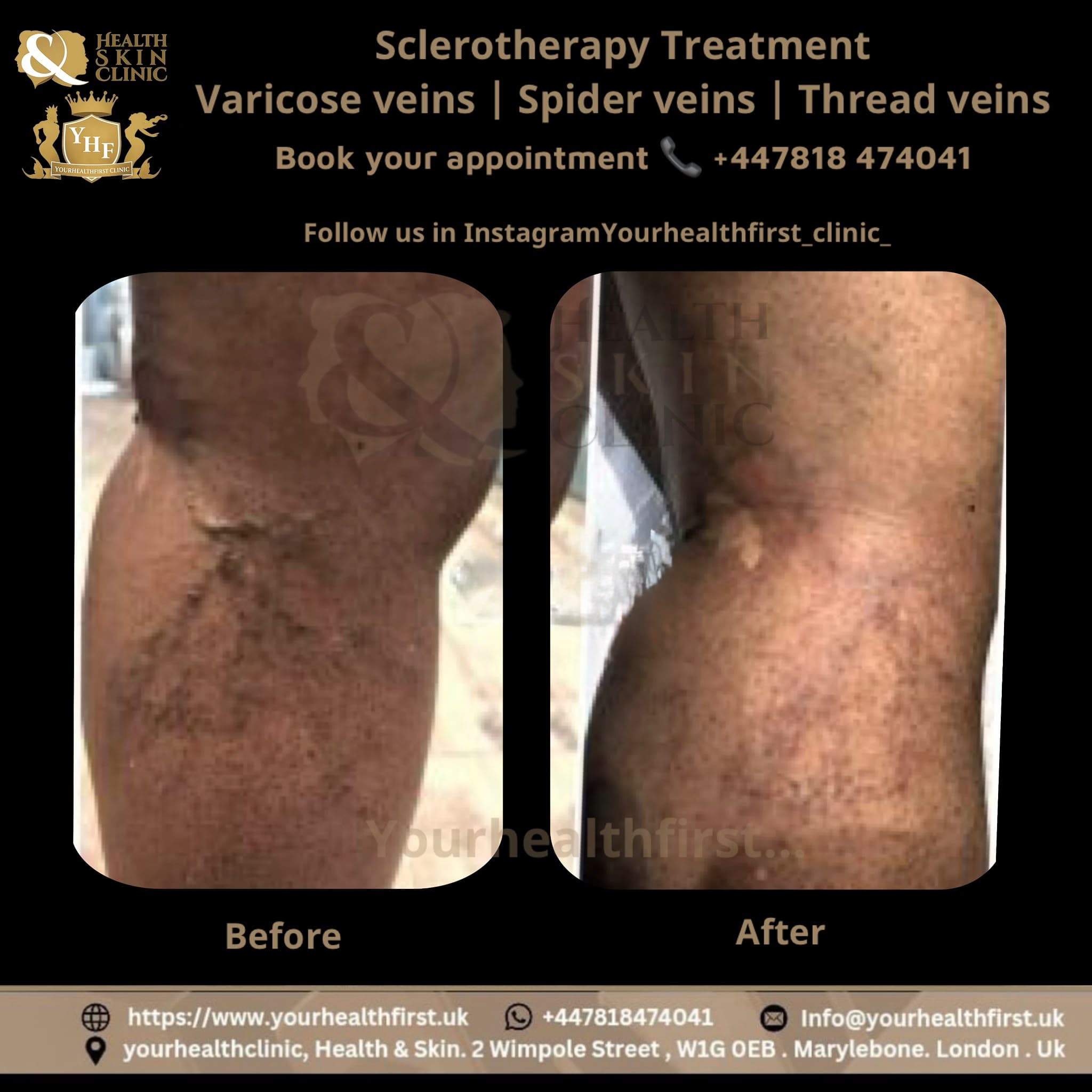 Sclerotherapy before & after — result 1