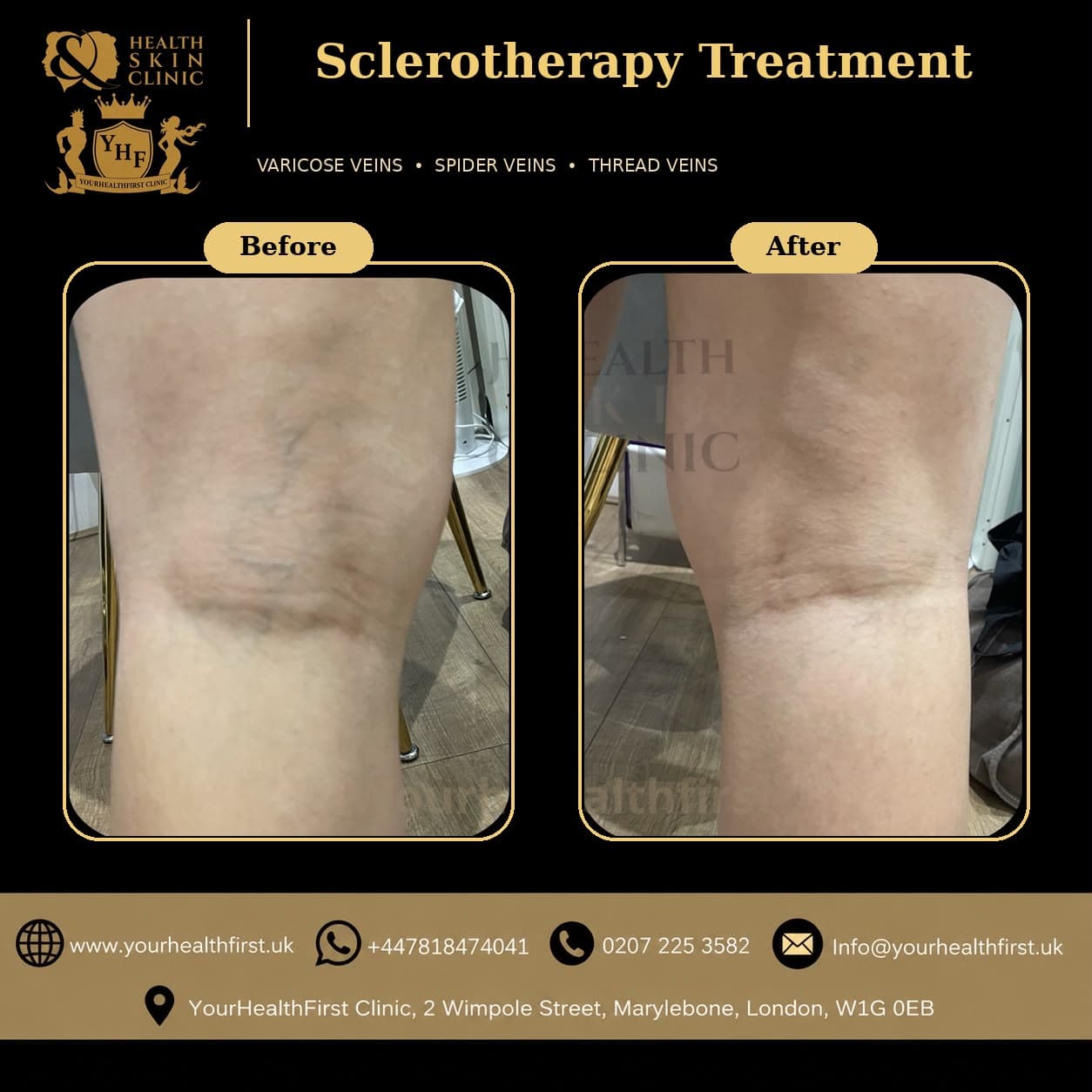Sclerotherapy before & after — result 2