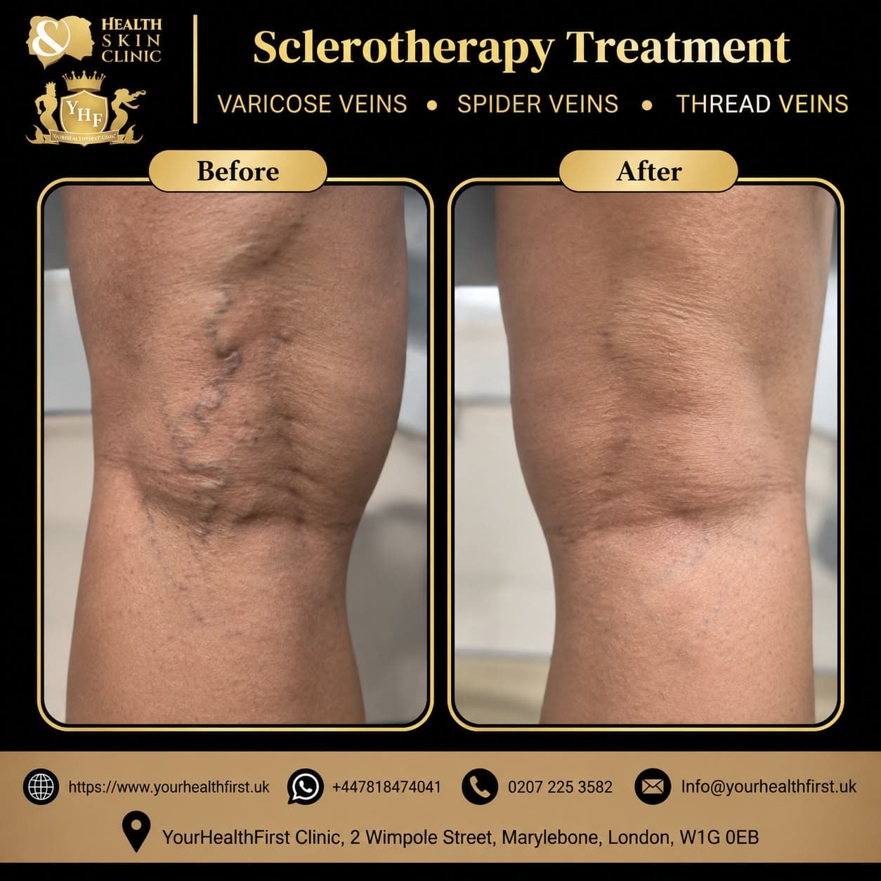 Sclerotherapy before & after — result 3