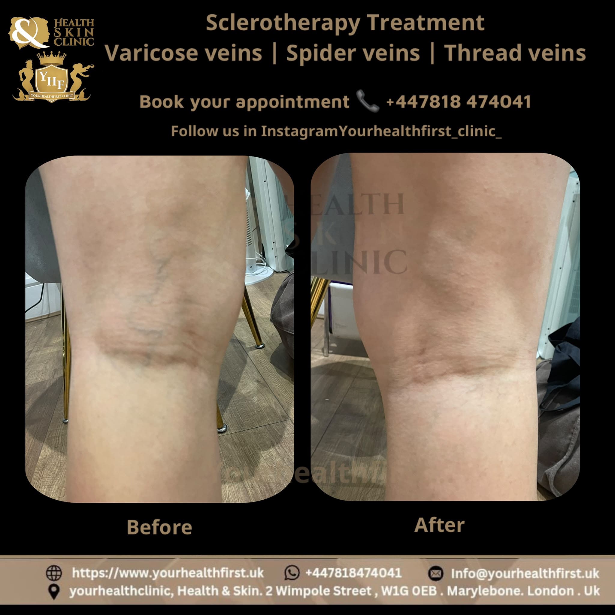 Sclerotherapy before & after — result 4