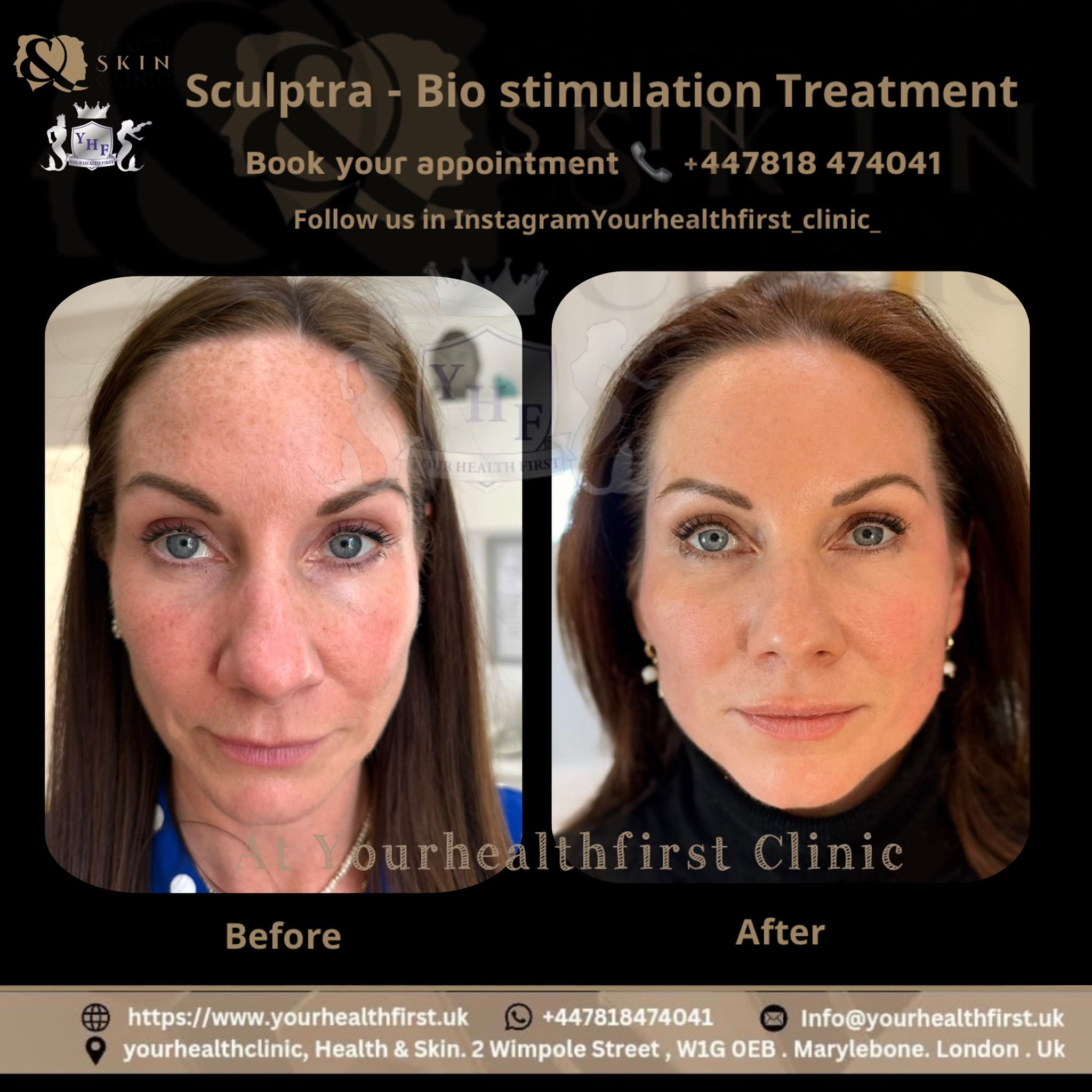 Sculptra before & after — result 1