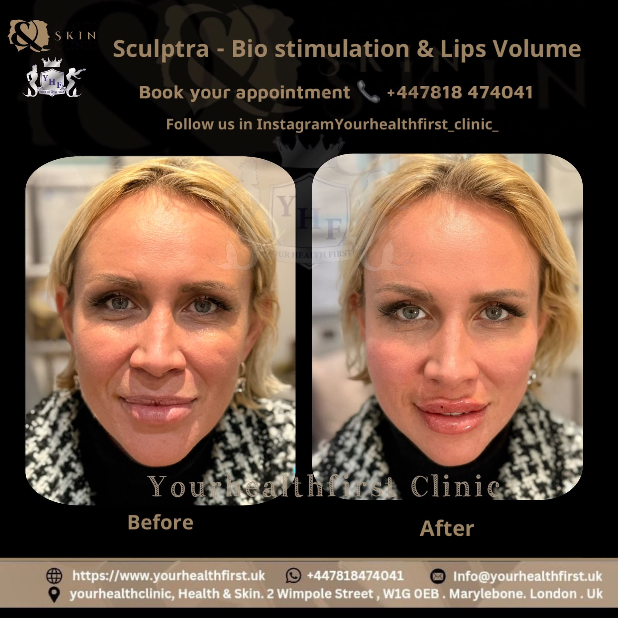Sculptra before & after — result 2