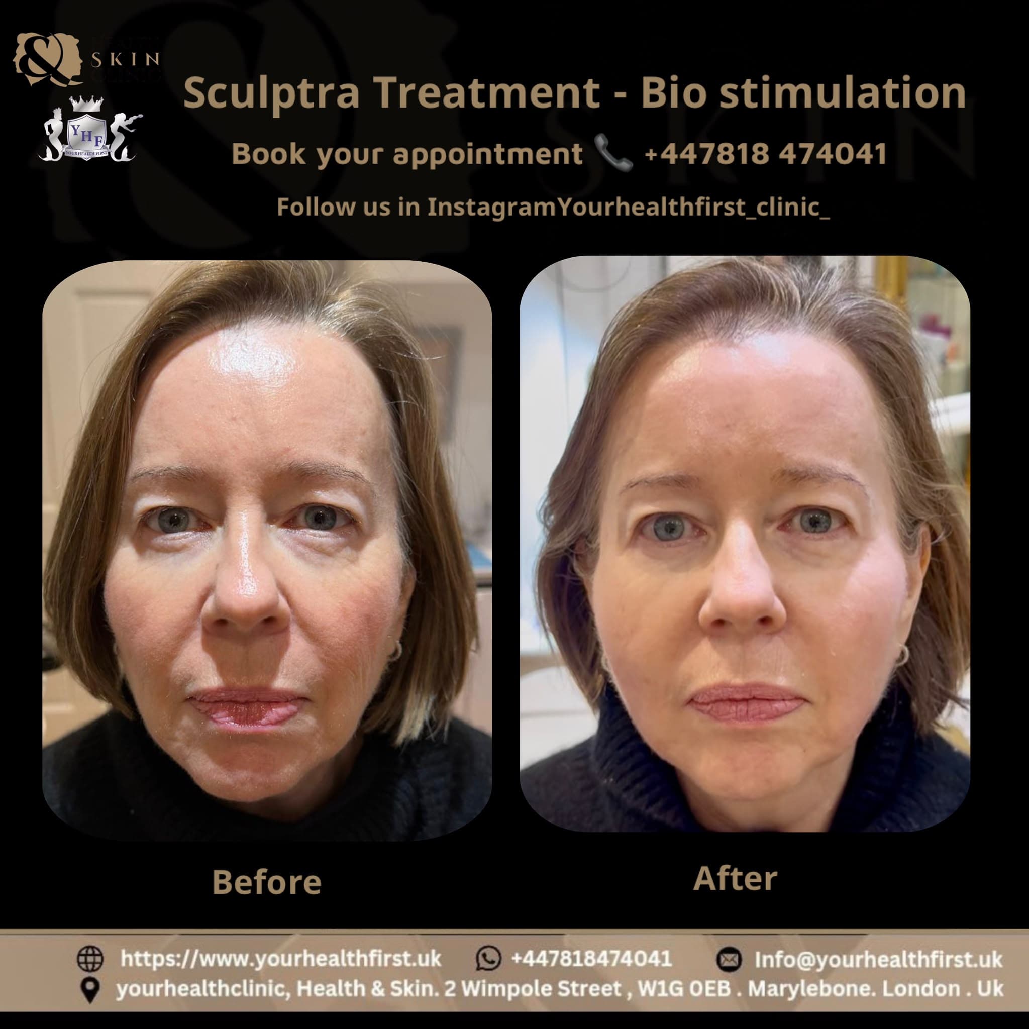 Sculptra before & after — result 3