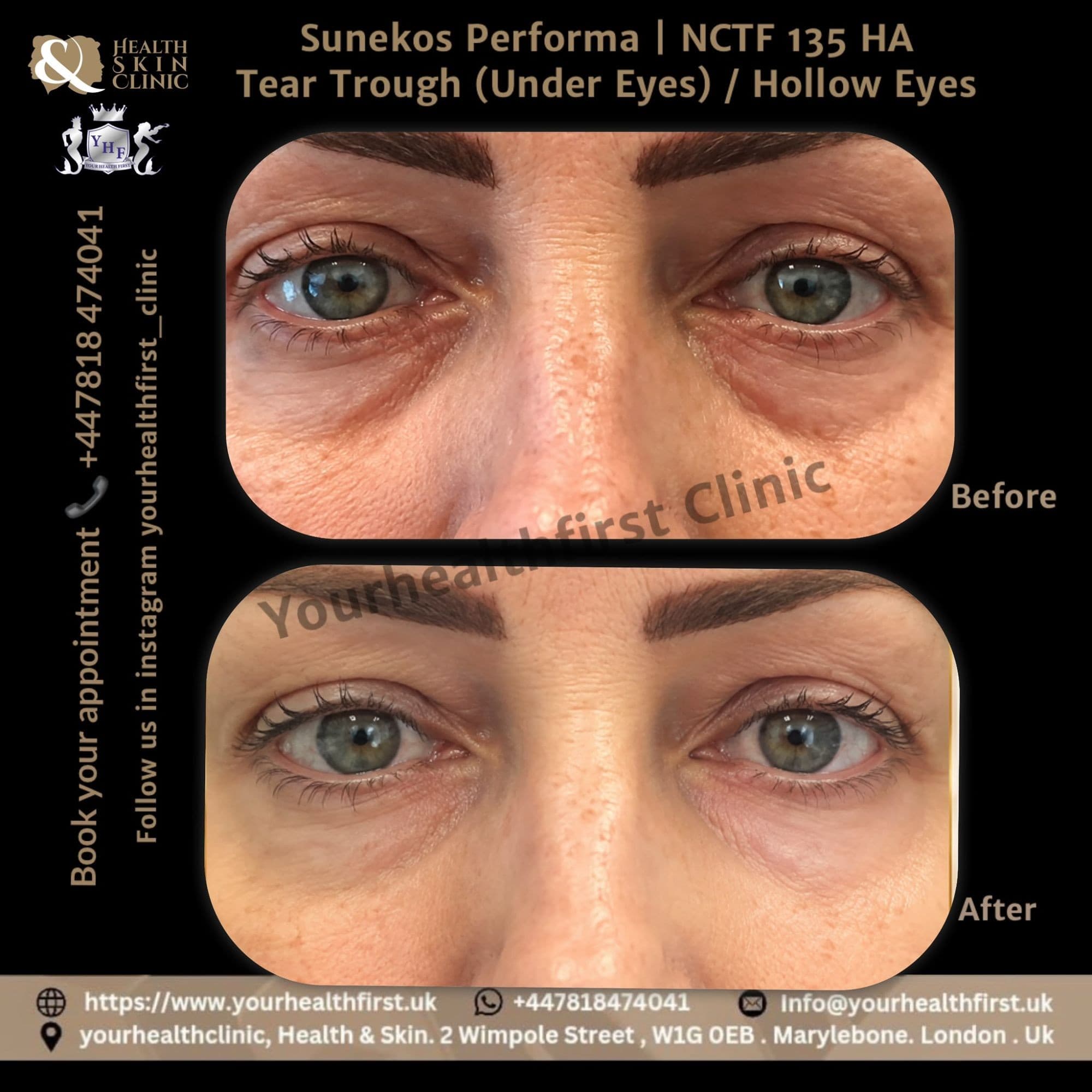 Sunekos tear trough before & after — result 4