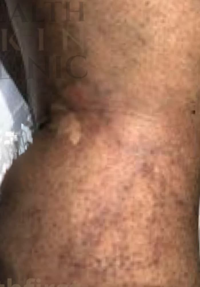 Sclerotherapy after — result 4