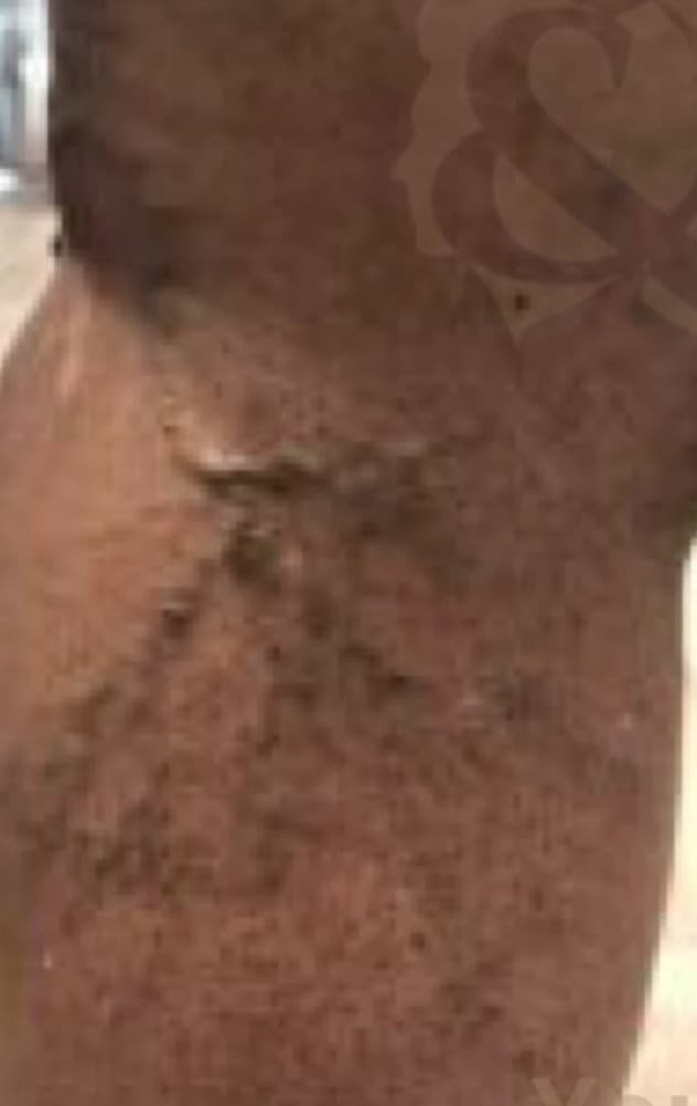 Sclerotherapy before — result 4