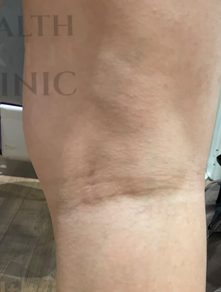 Sclerotherapy after — result 3