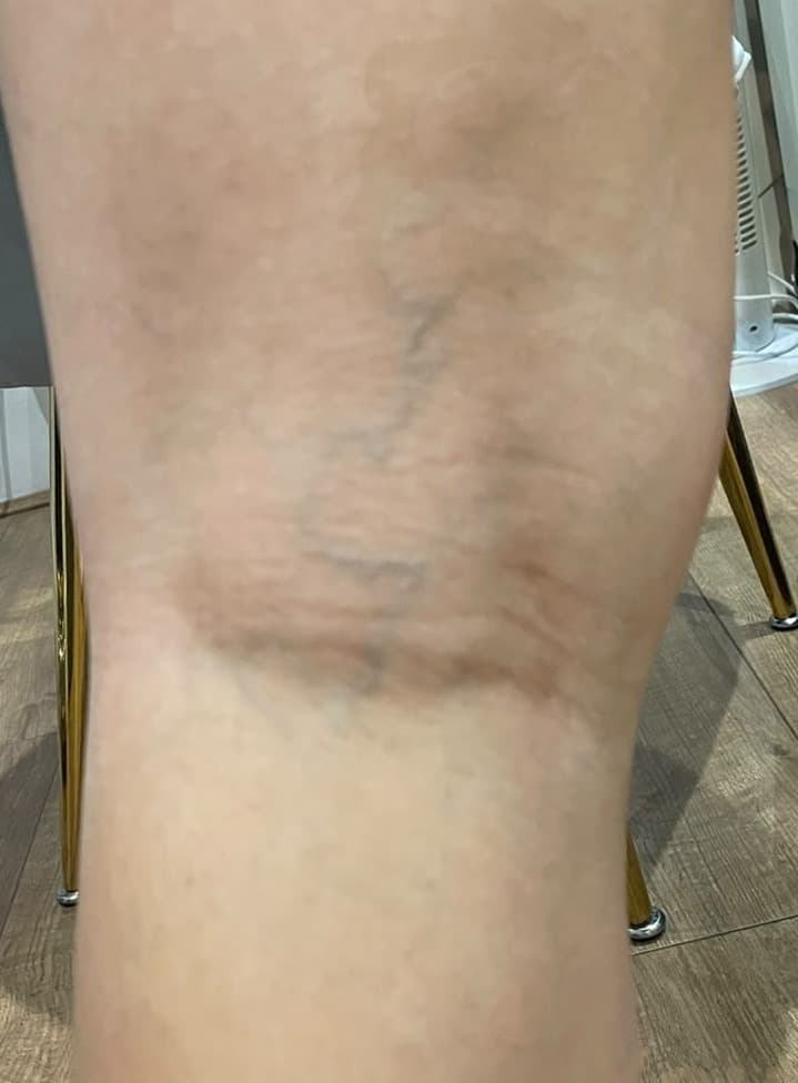 Sclerotherapy before — result 3