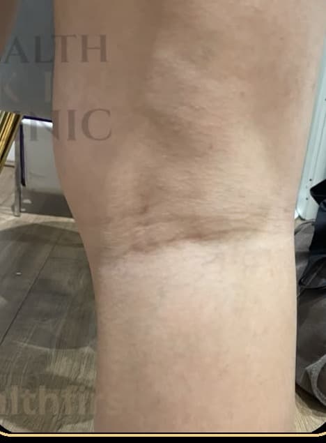 Leg with faded spider veins after sclerotherapy treatment