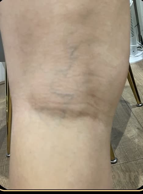 Leg with visible spider veins before sclerotherapy treatment