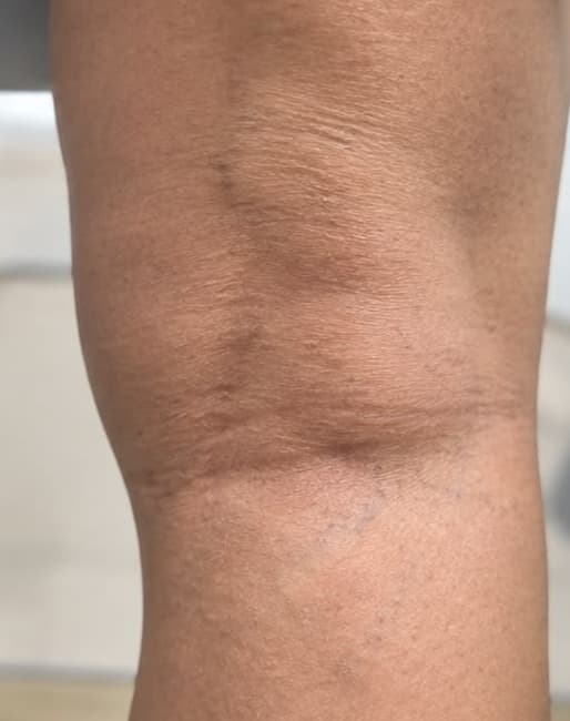Sclerotherapy after — result 2