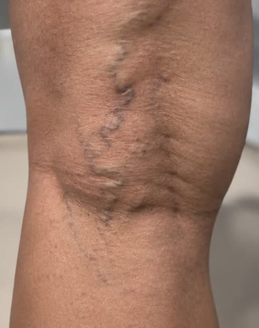 Sclerotherapy before — result 2