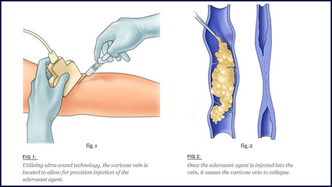 Diagram showing the sclerotherapy injection technique and vein collapse