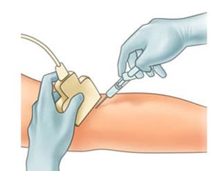 Using ultrasound guidance to locate the varicose vein for precision injection