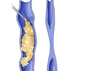 The sclerosant agent causing the varicose vein to collapse