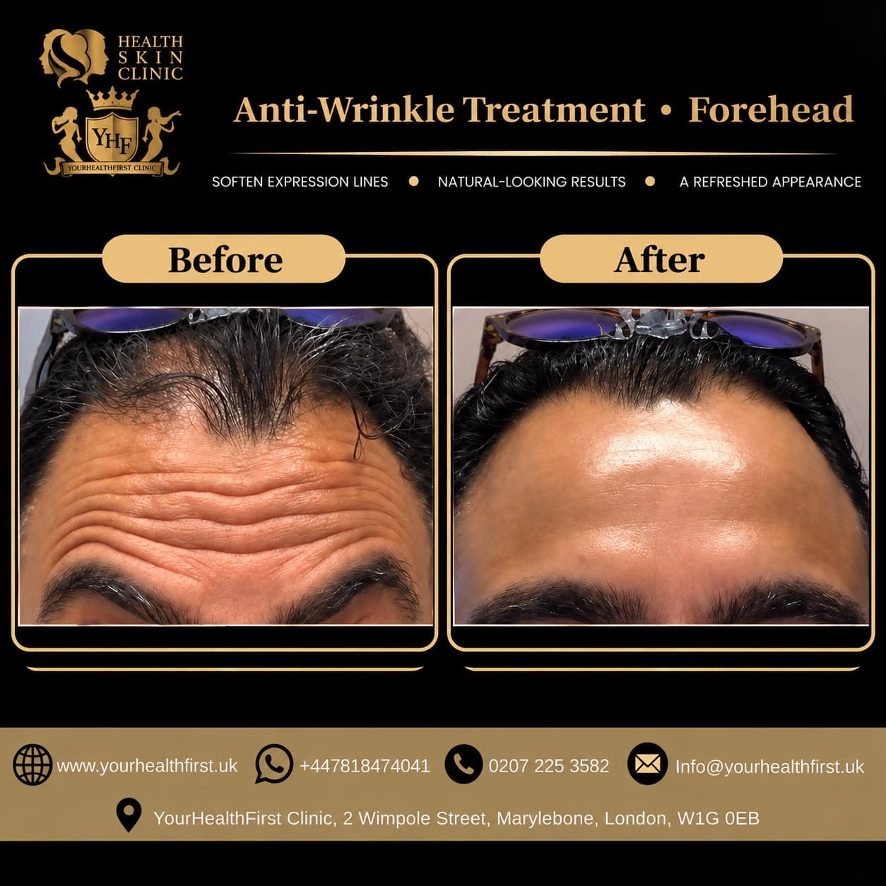 Anti-Wrinkle Injections before & after — result 1