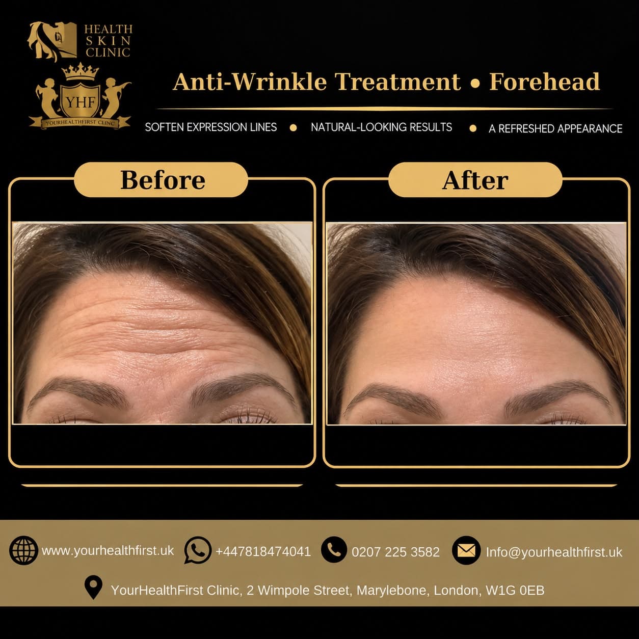 Anti-Wrinkle Injections before & after — result 2