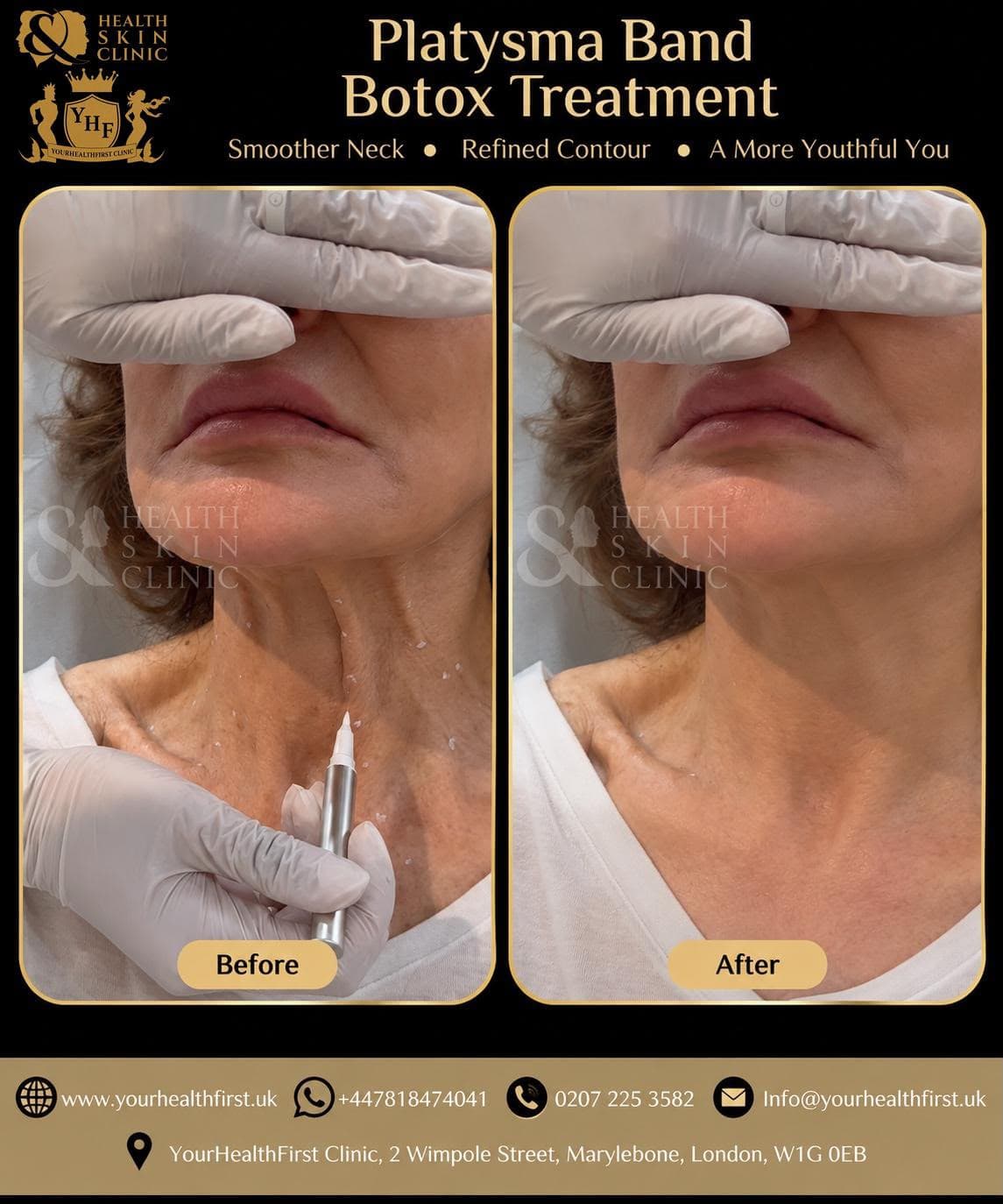 Anti-Wrinkle Injections before & after — result 3
