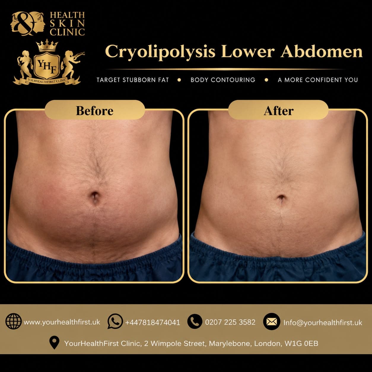 Cryolipolysis (Fat Freezing) before & after — result 1