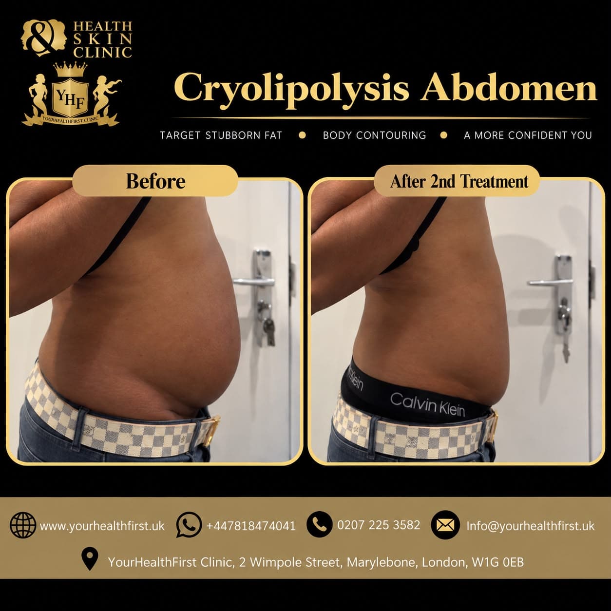 Cryolipolysis (Fat Freezing) before & after — result 2