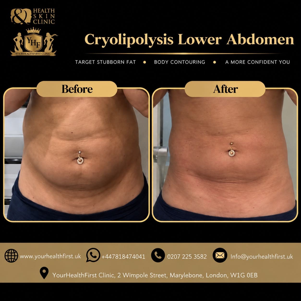 Cryolipolysis (Fat Freezing) before & after — result 3
