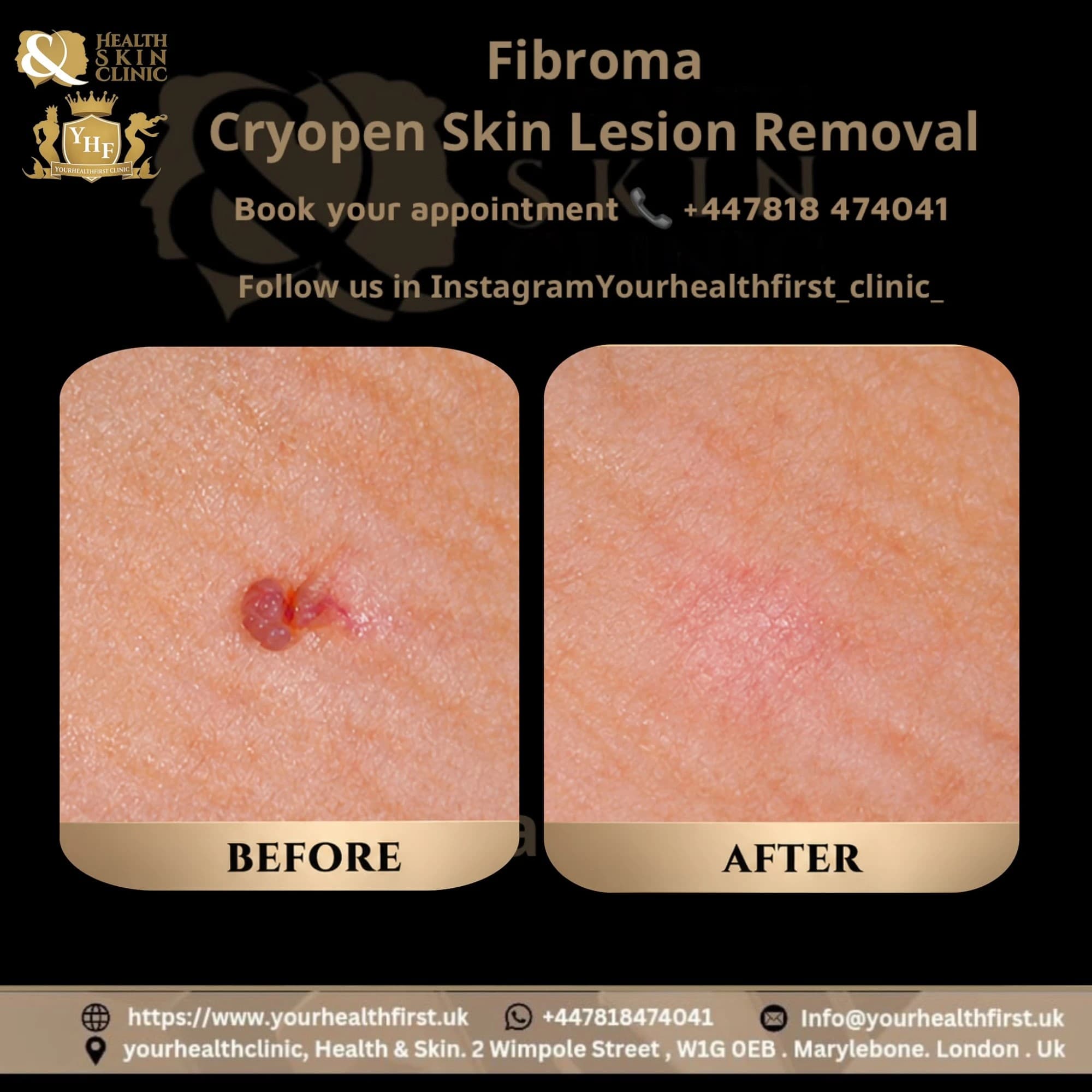 CryoPen, Precise Treatment for Benign Skin Lesions before & after — result 1