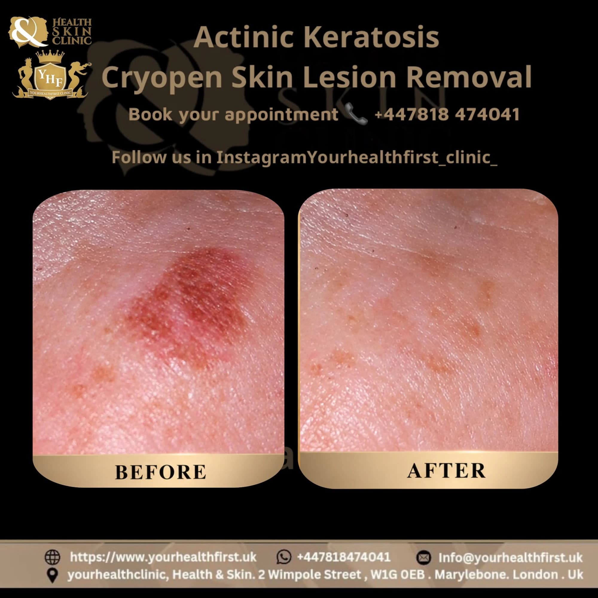 CryoPen, Precise Treatment for Benign Skin Lesions before & after — result 2