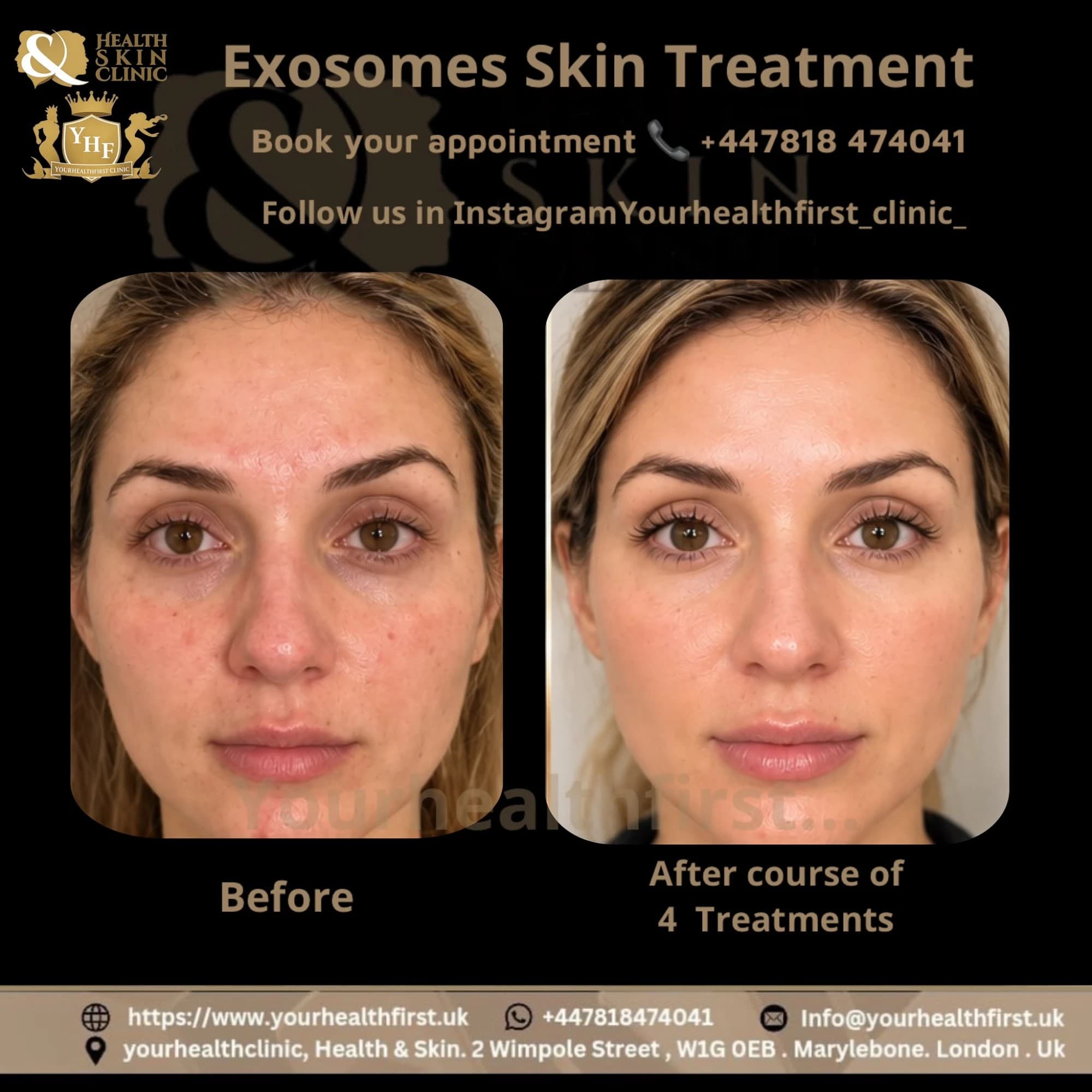 Exosomes: The Game-Changing Beauty Secret before & after — result 1