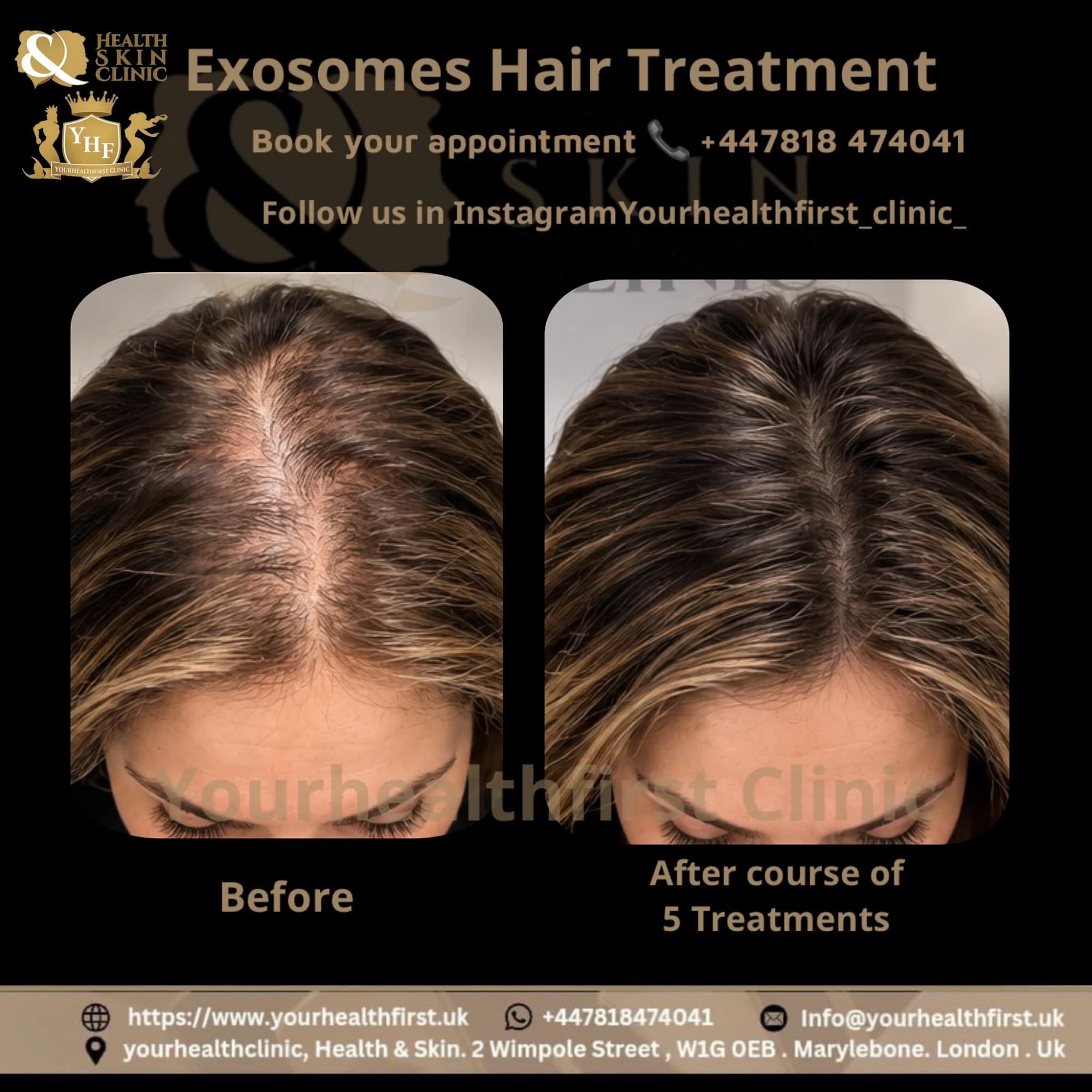 Exosomes: The Game-Changing Beauty Secret before & after — result 2