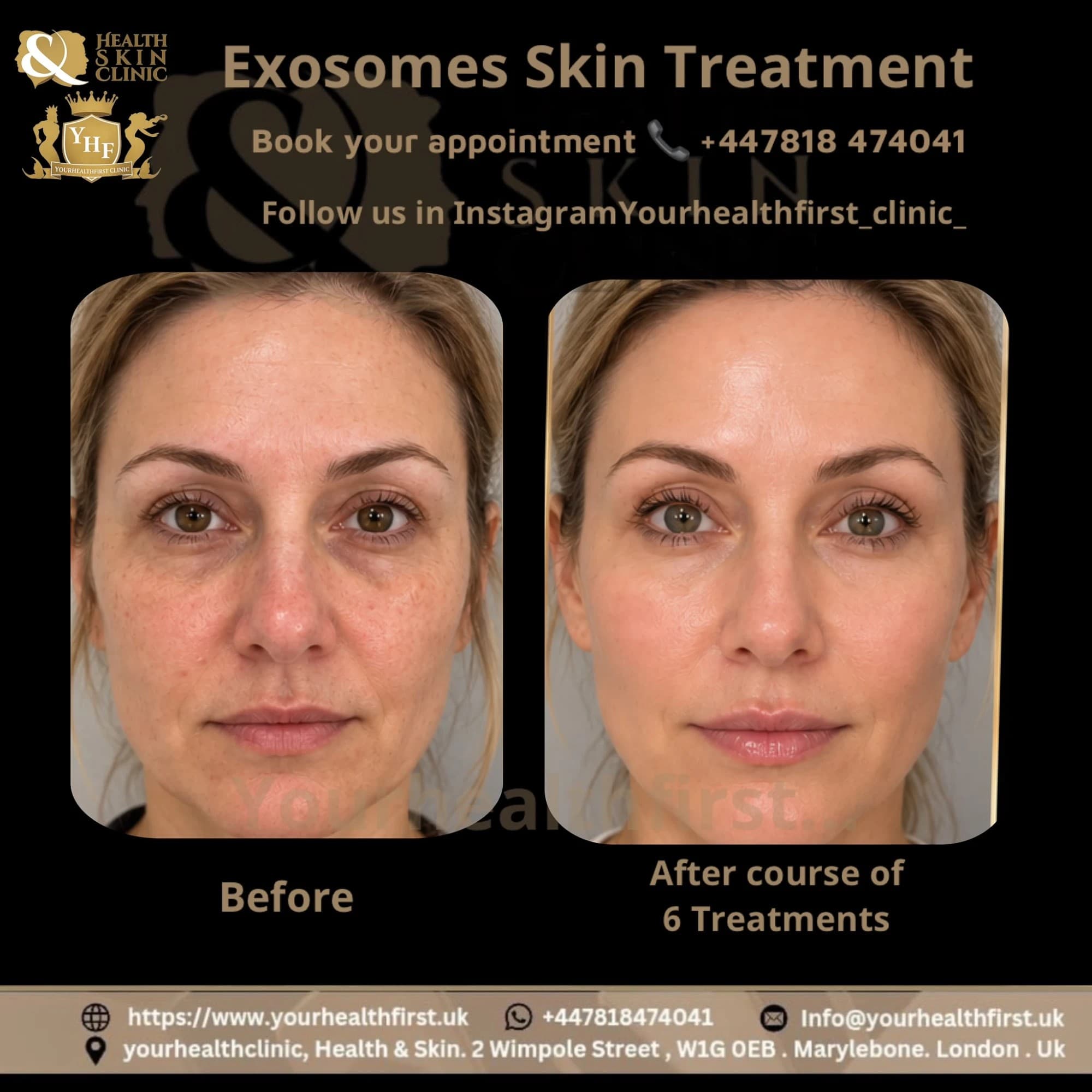 Exosomes: The Game-Changing Beauty Secret before & after — result 3