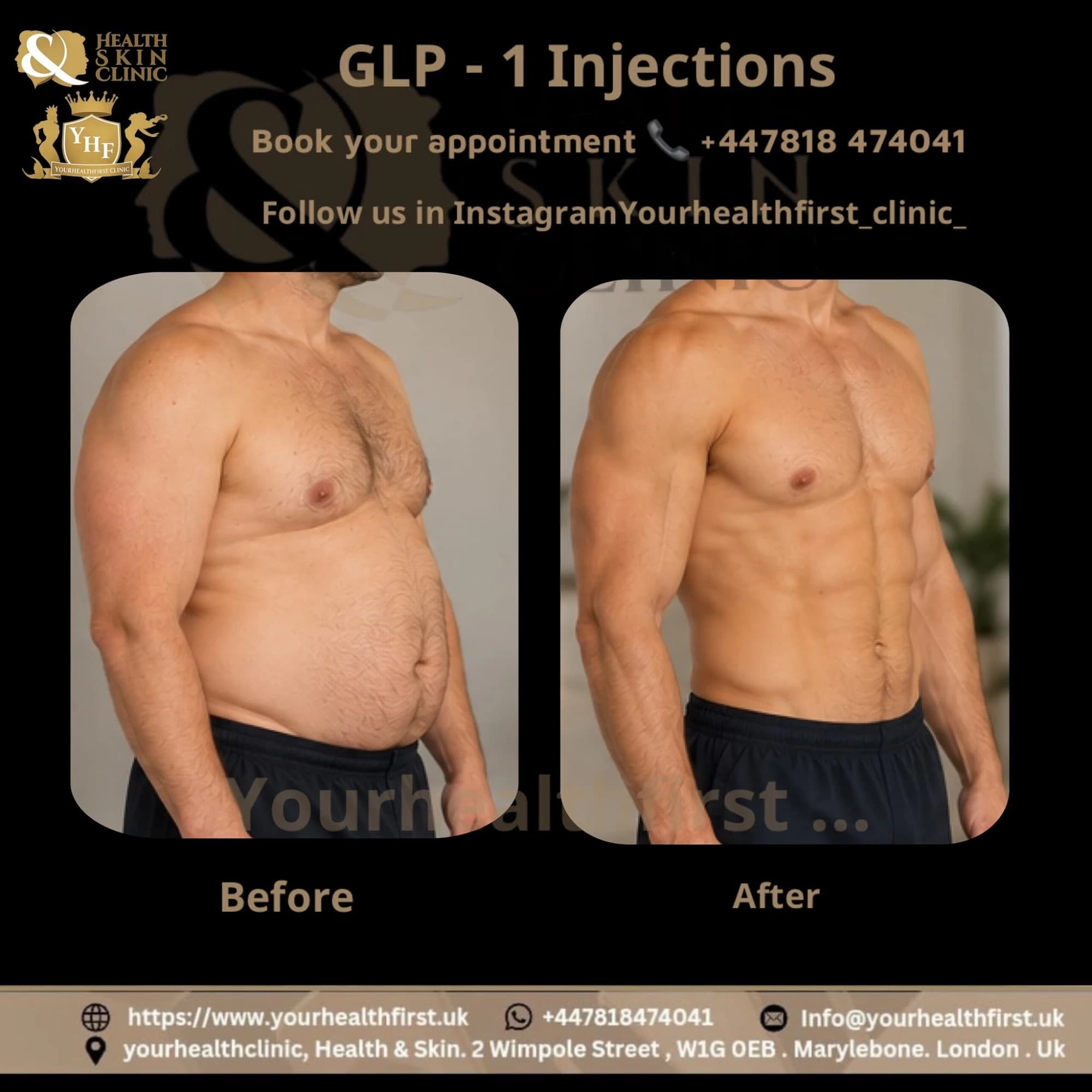 Mounjaro (Weight Loss Injection) before & after — result 1