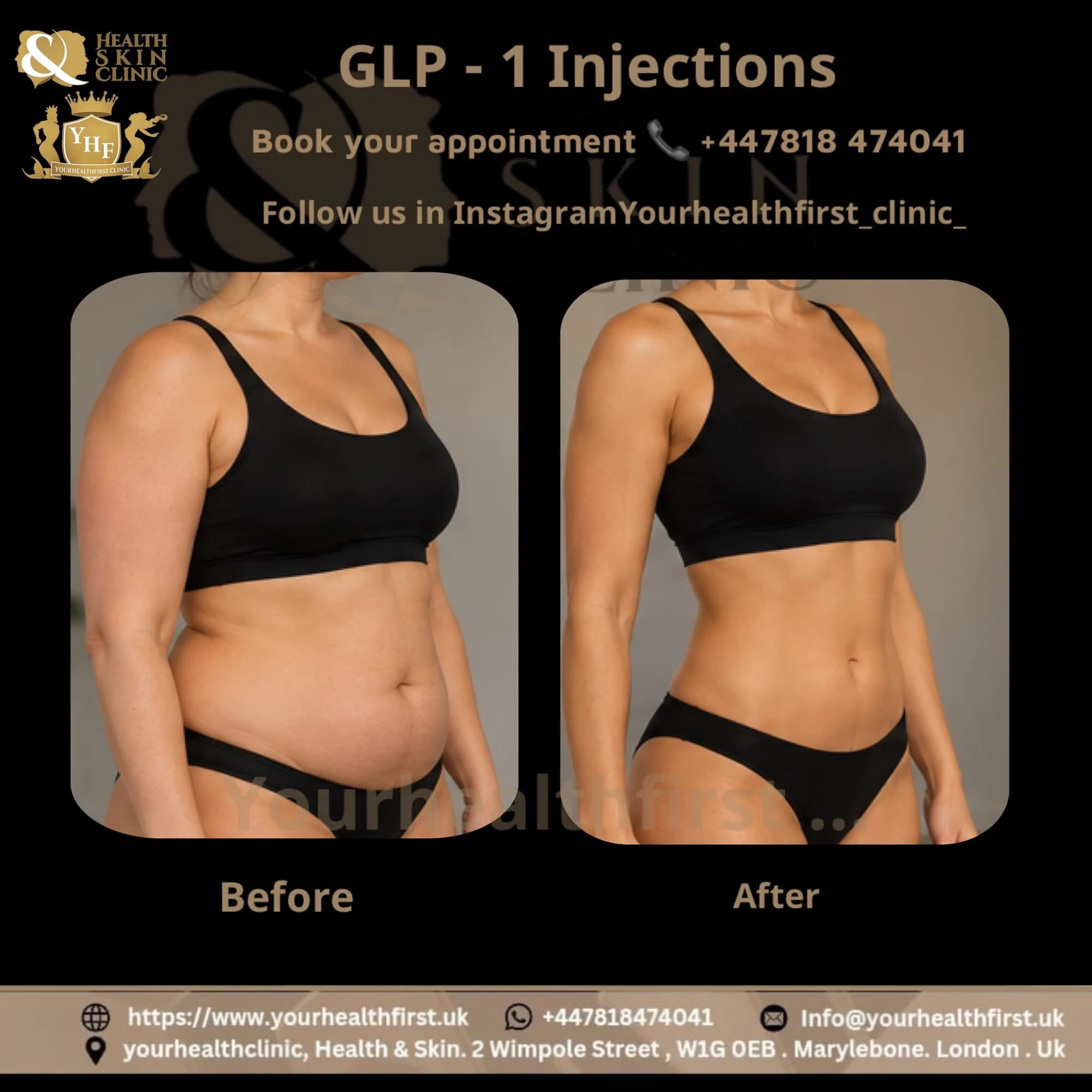Mounjaro (Weight Loss Injection) before & after — result 2