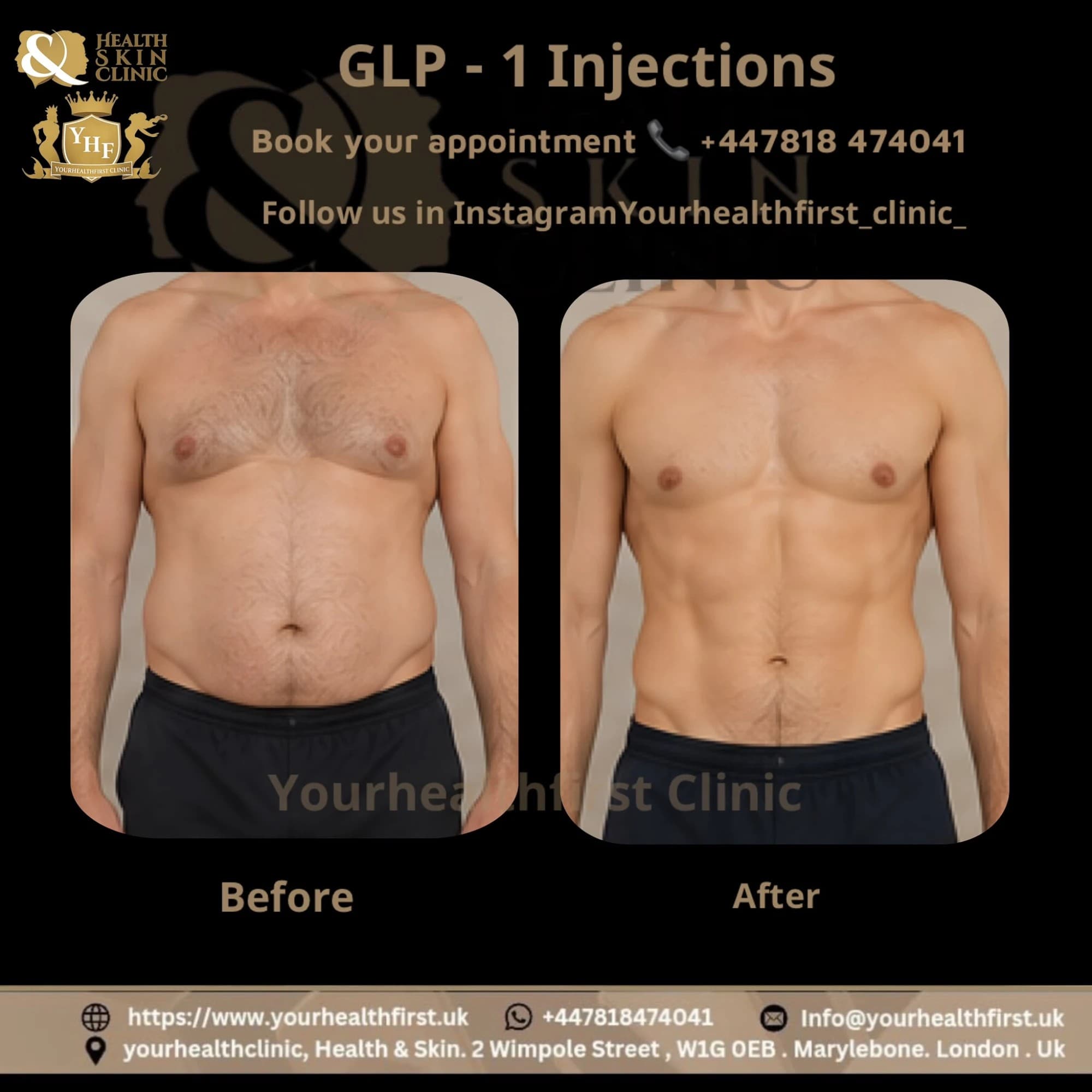 Mounjaro (Weight Loss Injection) before & after — result 3
