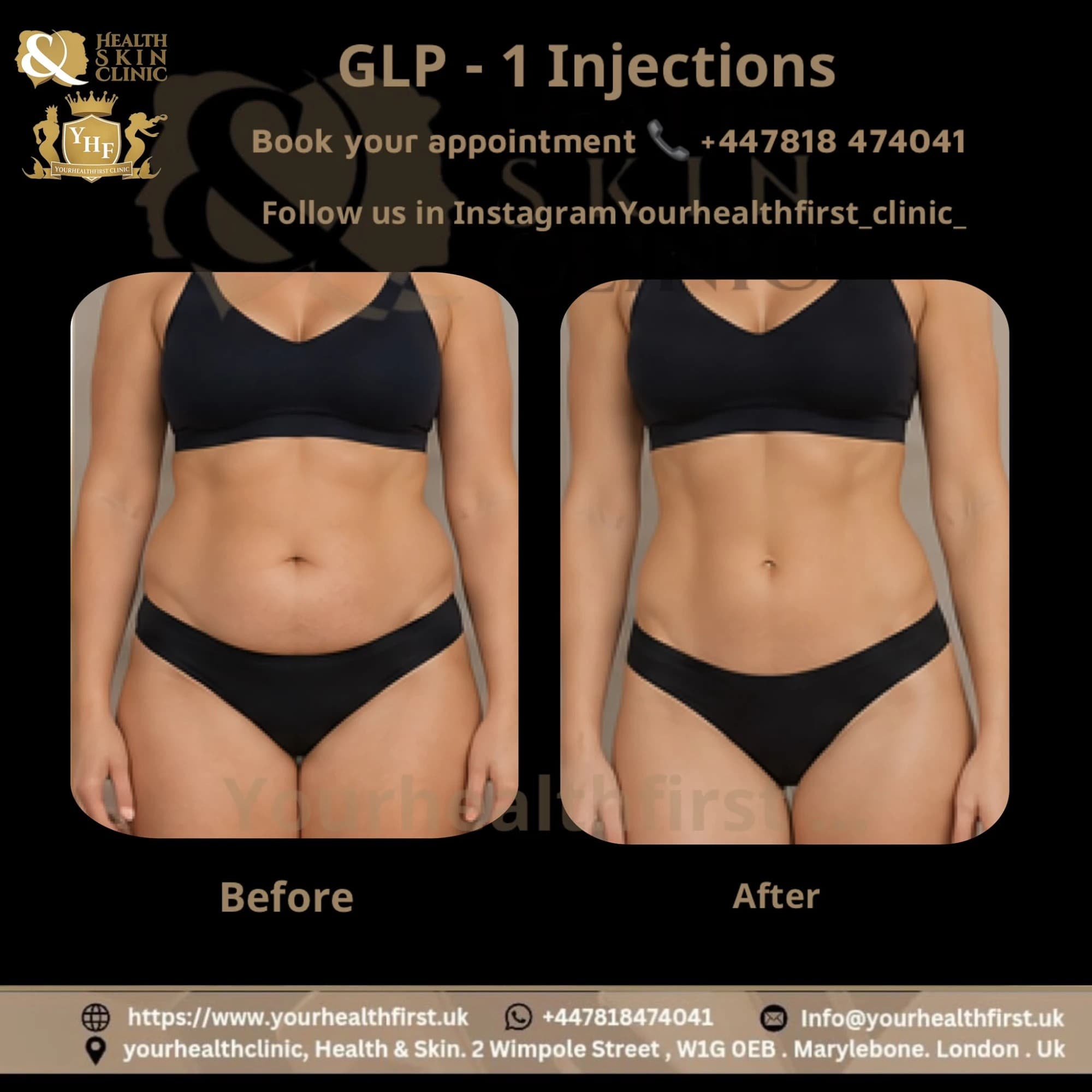 GLP-1 weight loss injections before & after — result 4