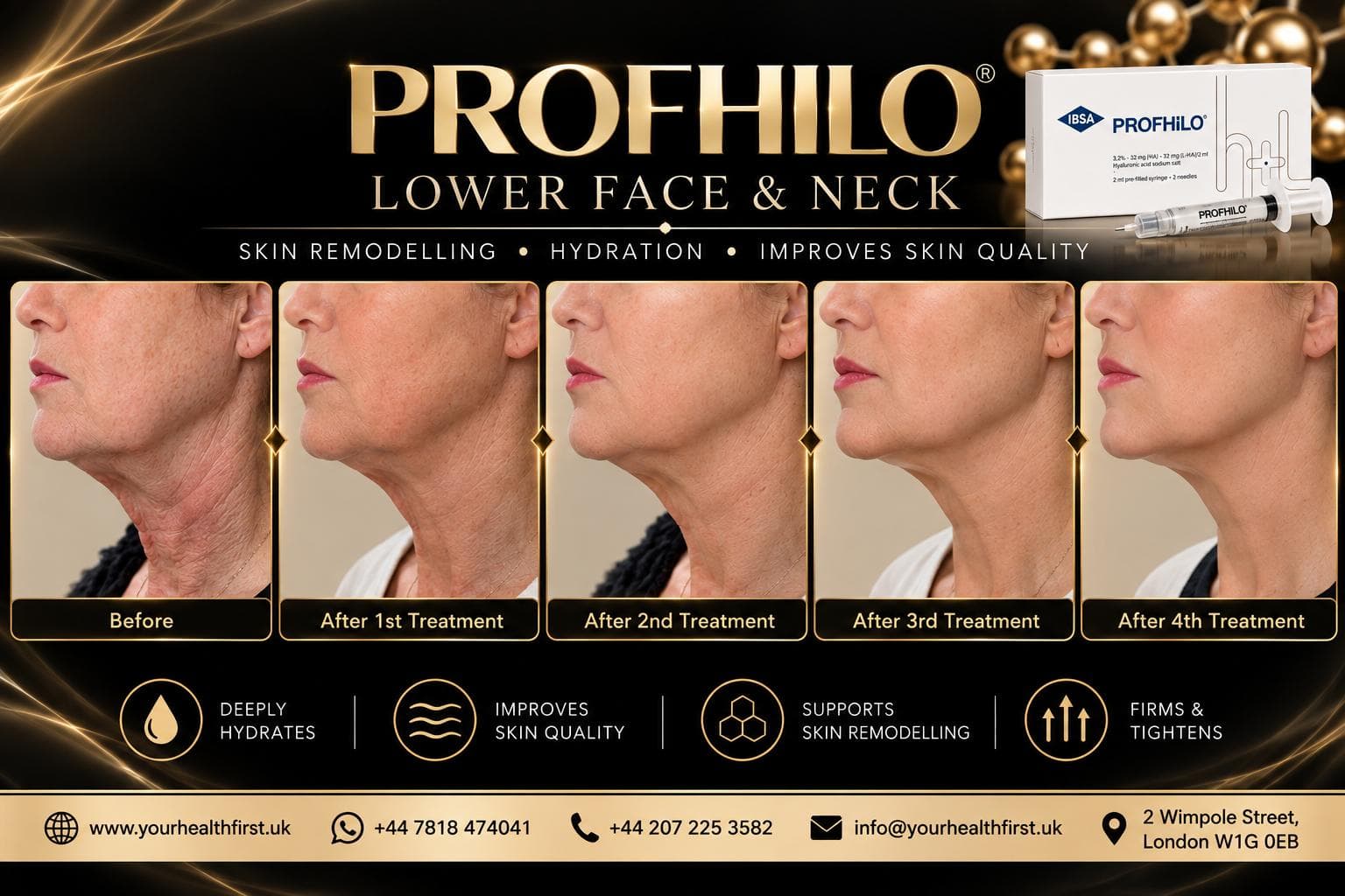 Profhilo before & after — result 1