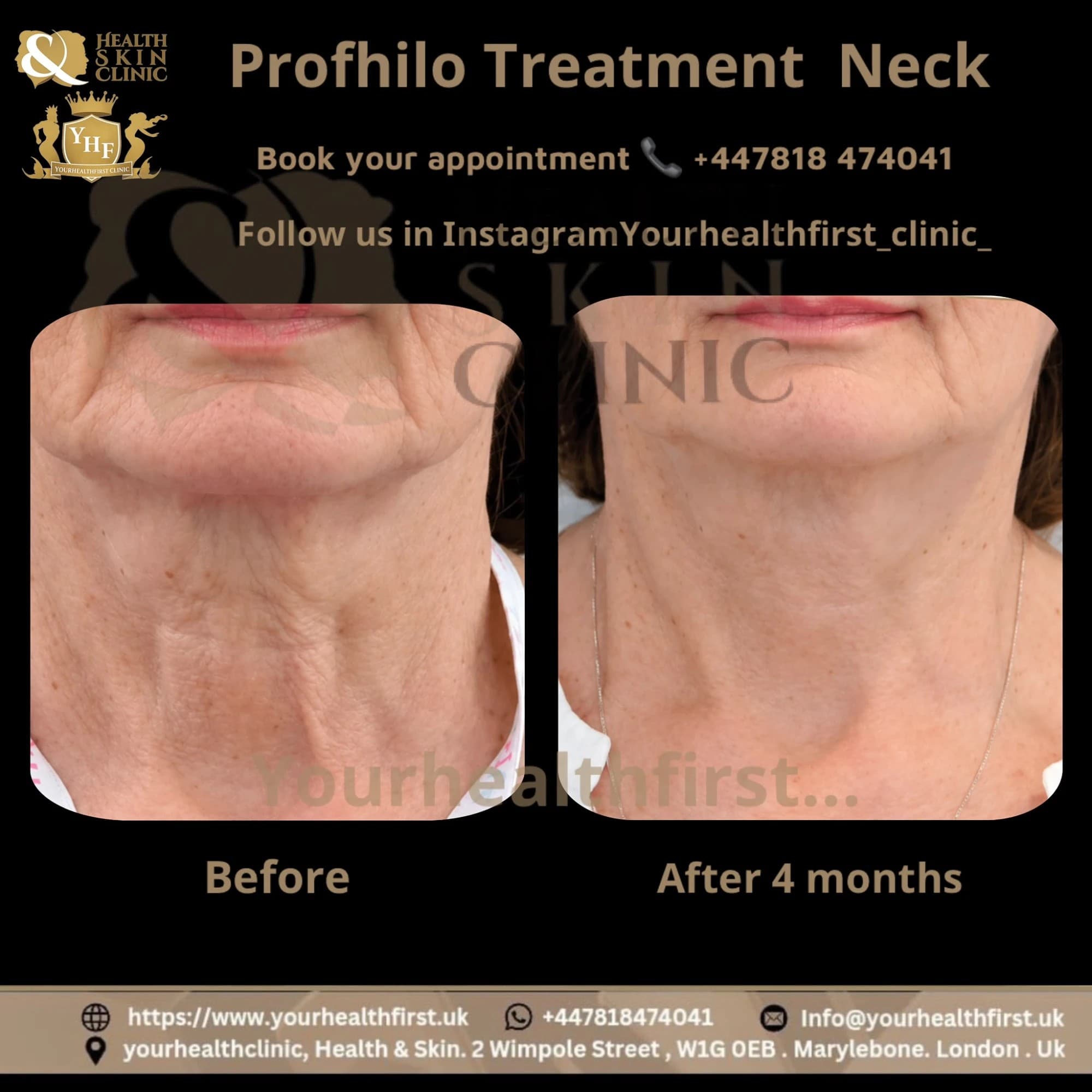 Profhilo before & after — result 2