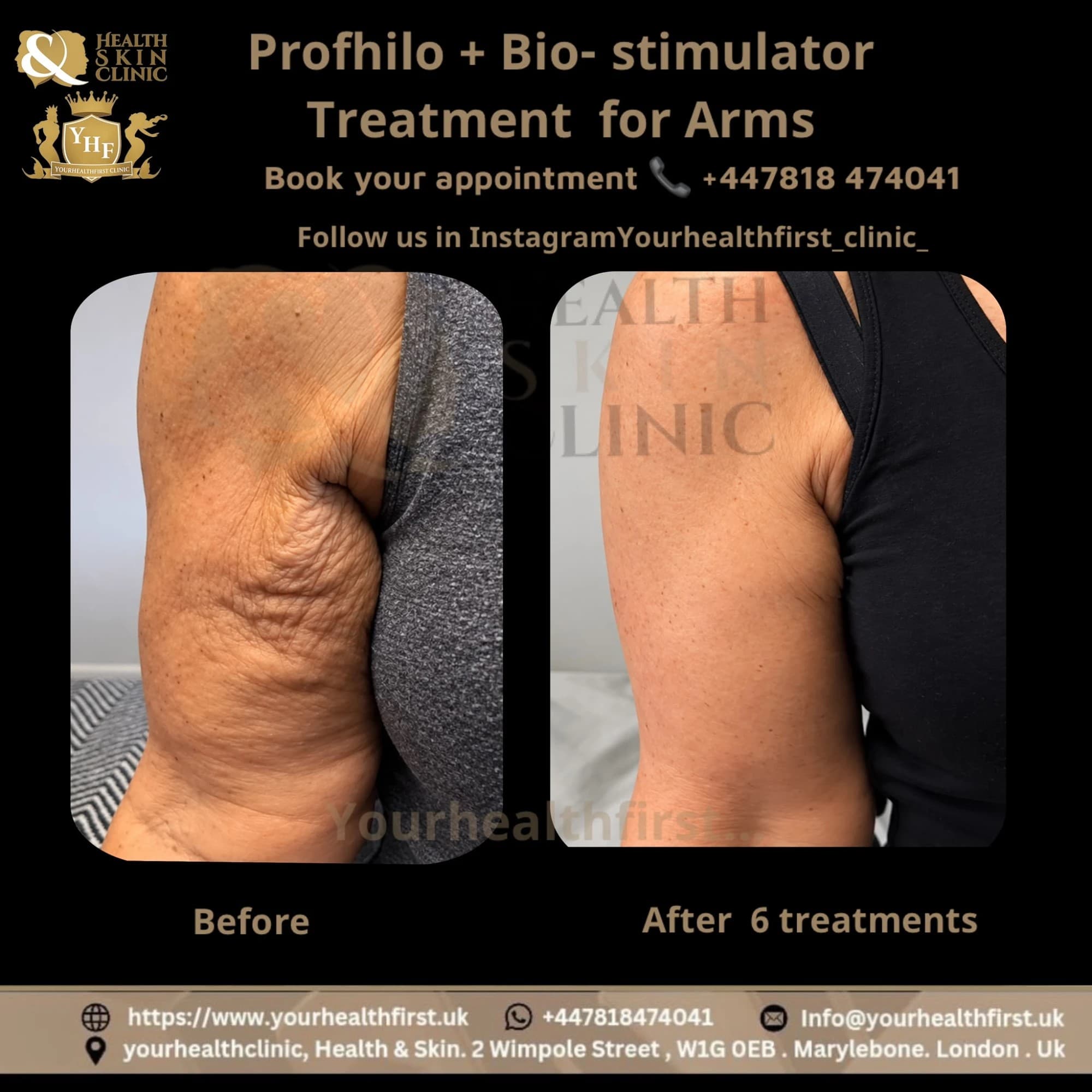 Profhilo before & after — result 3