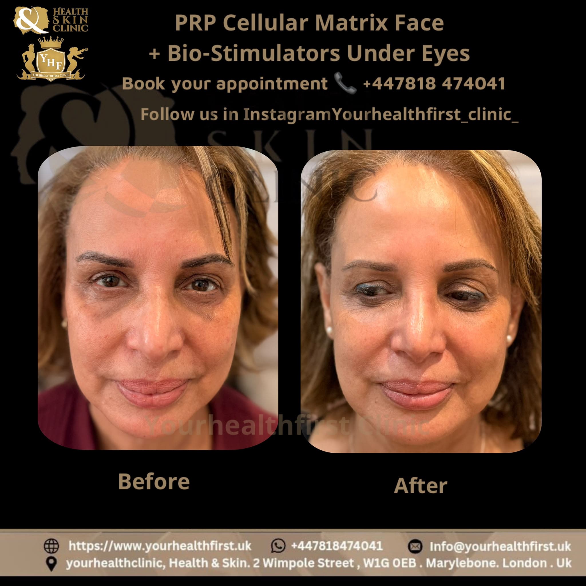 PRP Cellular Matrix Face + Bio-Stimulators Under Eyes before and after