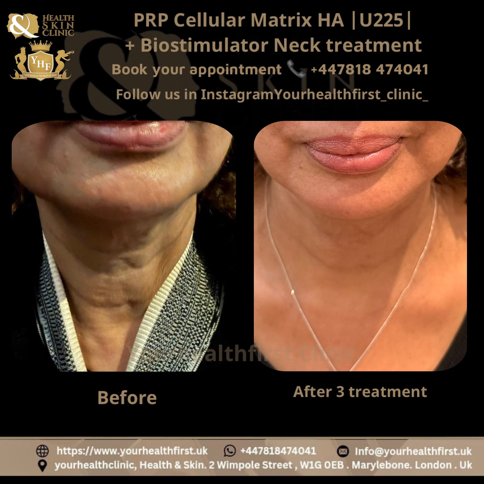 PRP Cellular Matrix HA U225 + Biostimulator Neck treatment before and after