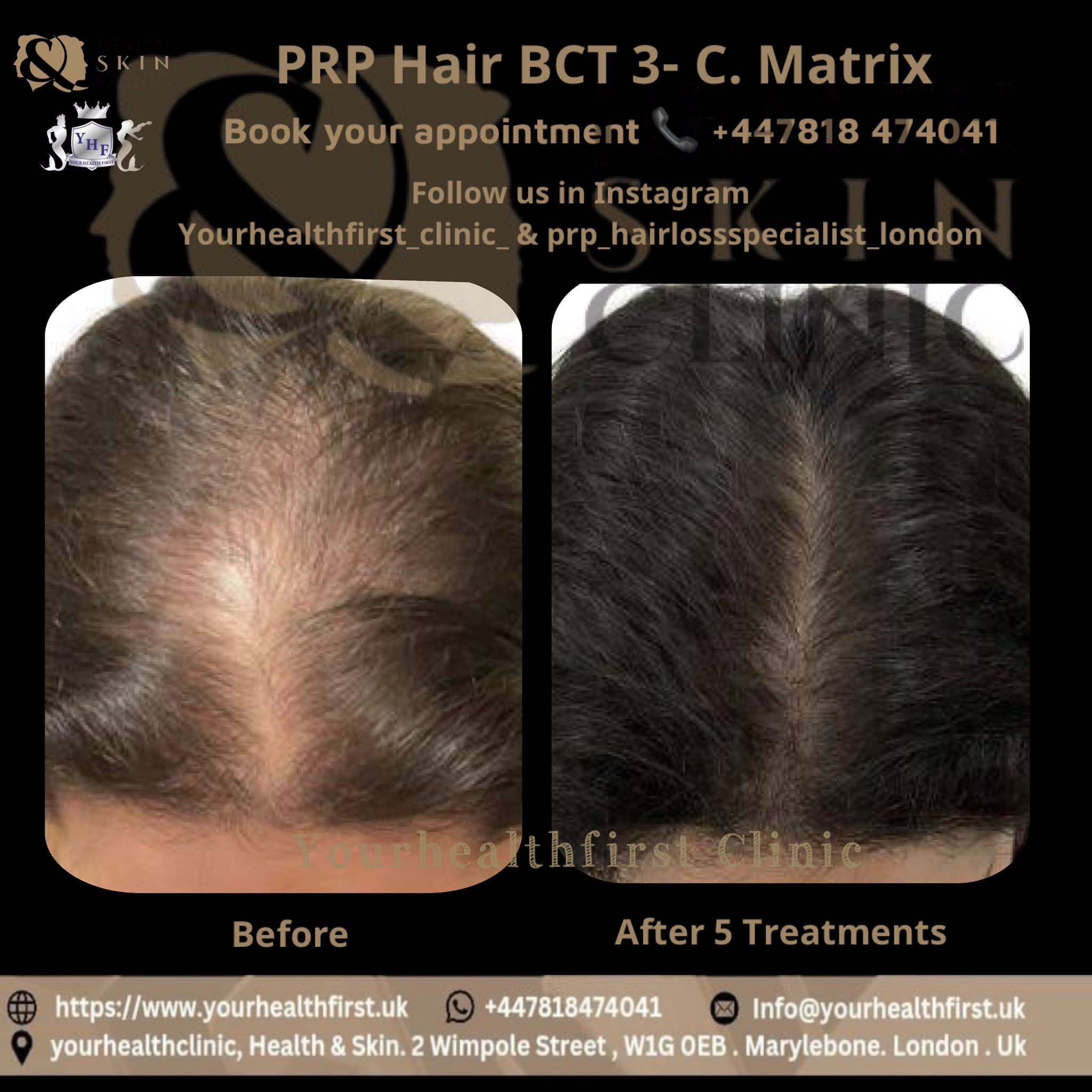 PRP hair loss (women) before & after — result 1